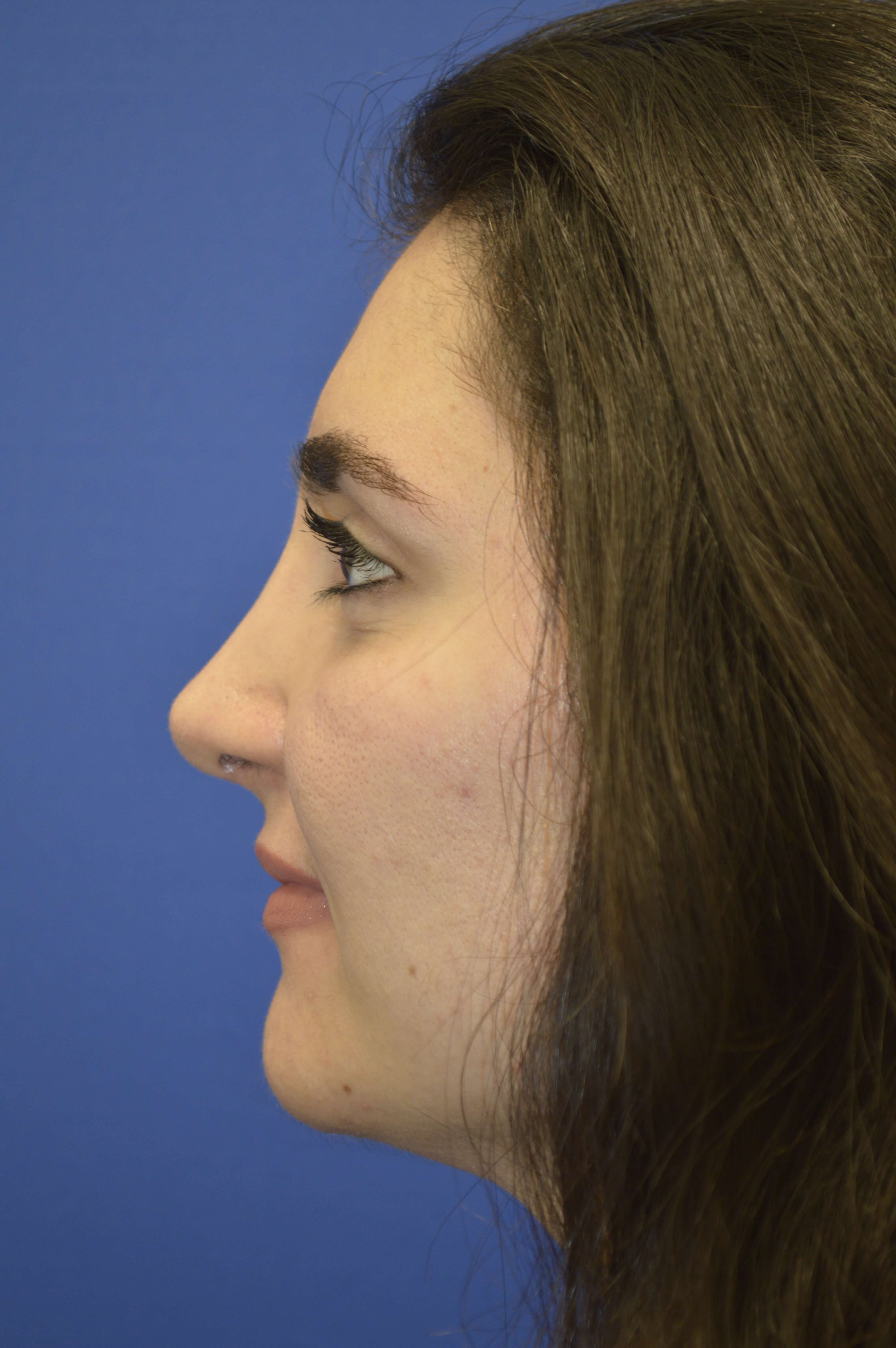 Rhinoplasty Washington DC After-Profile