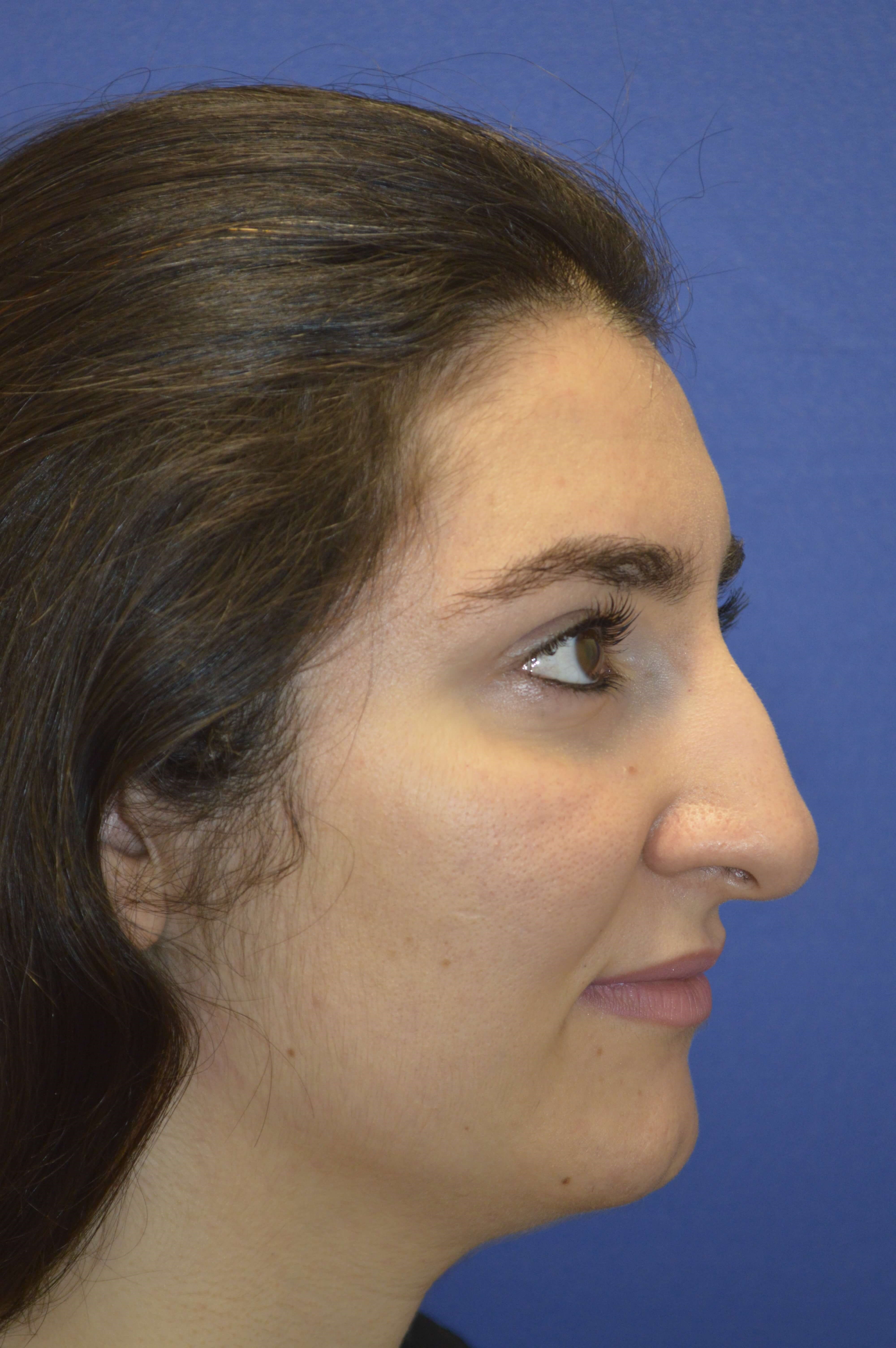 Rhinoplasty Washington DC Before