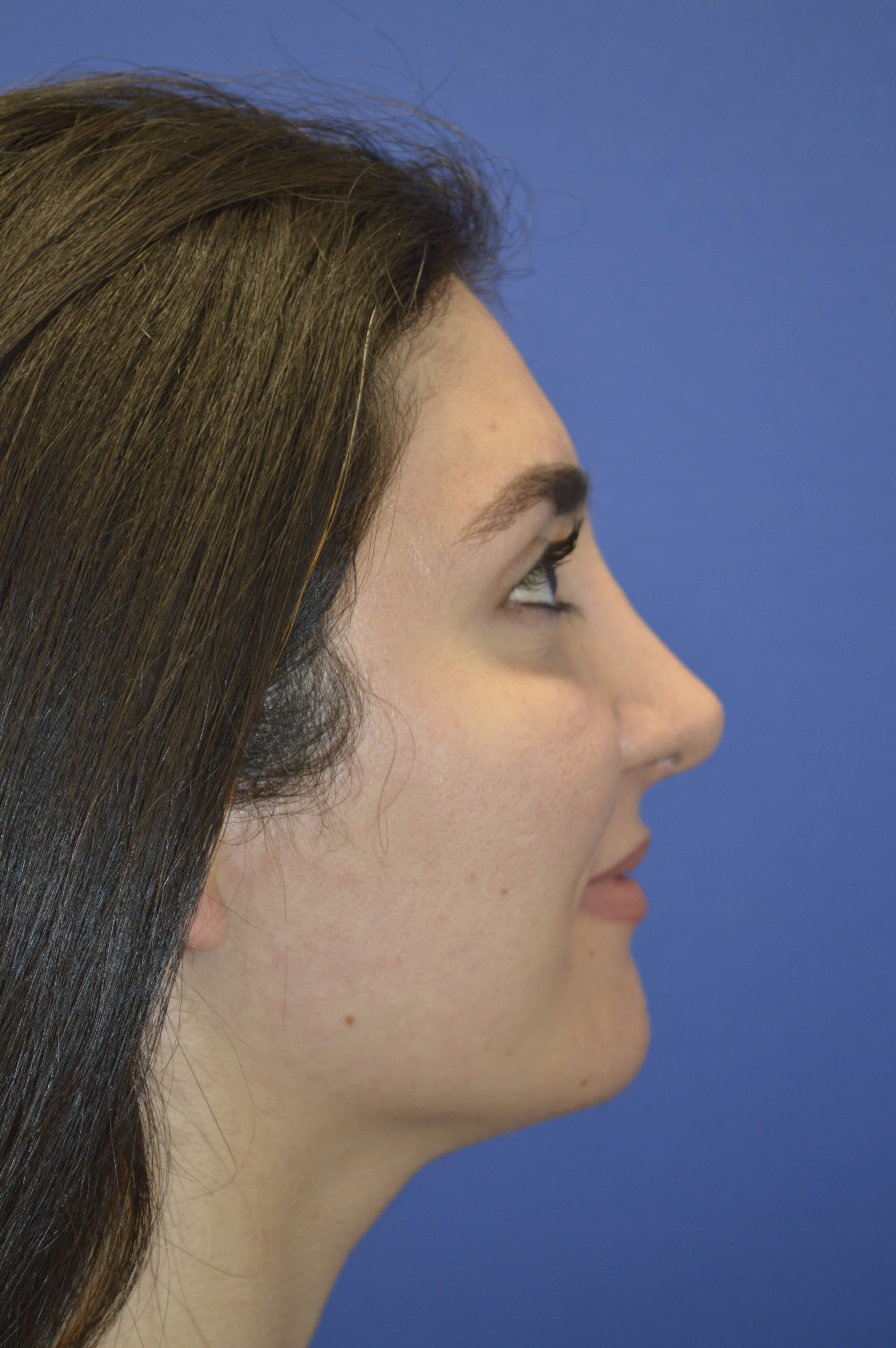 Rhinoplasty Washington DC After