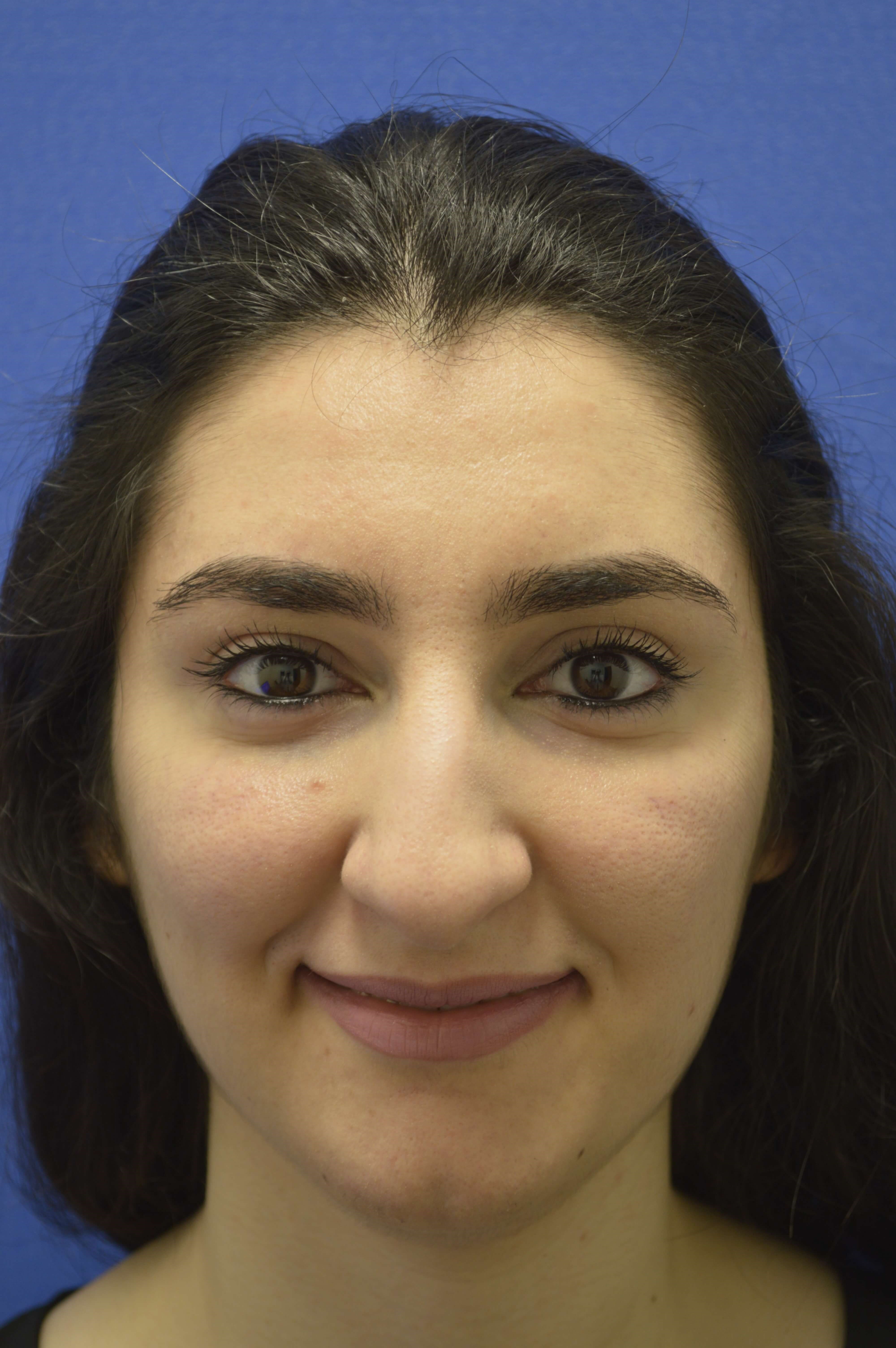 Rhinoplasty Washington DC Before-front view