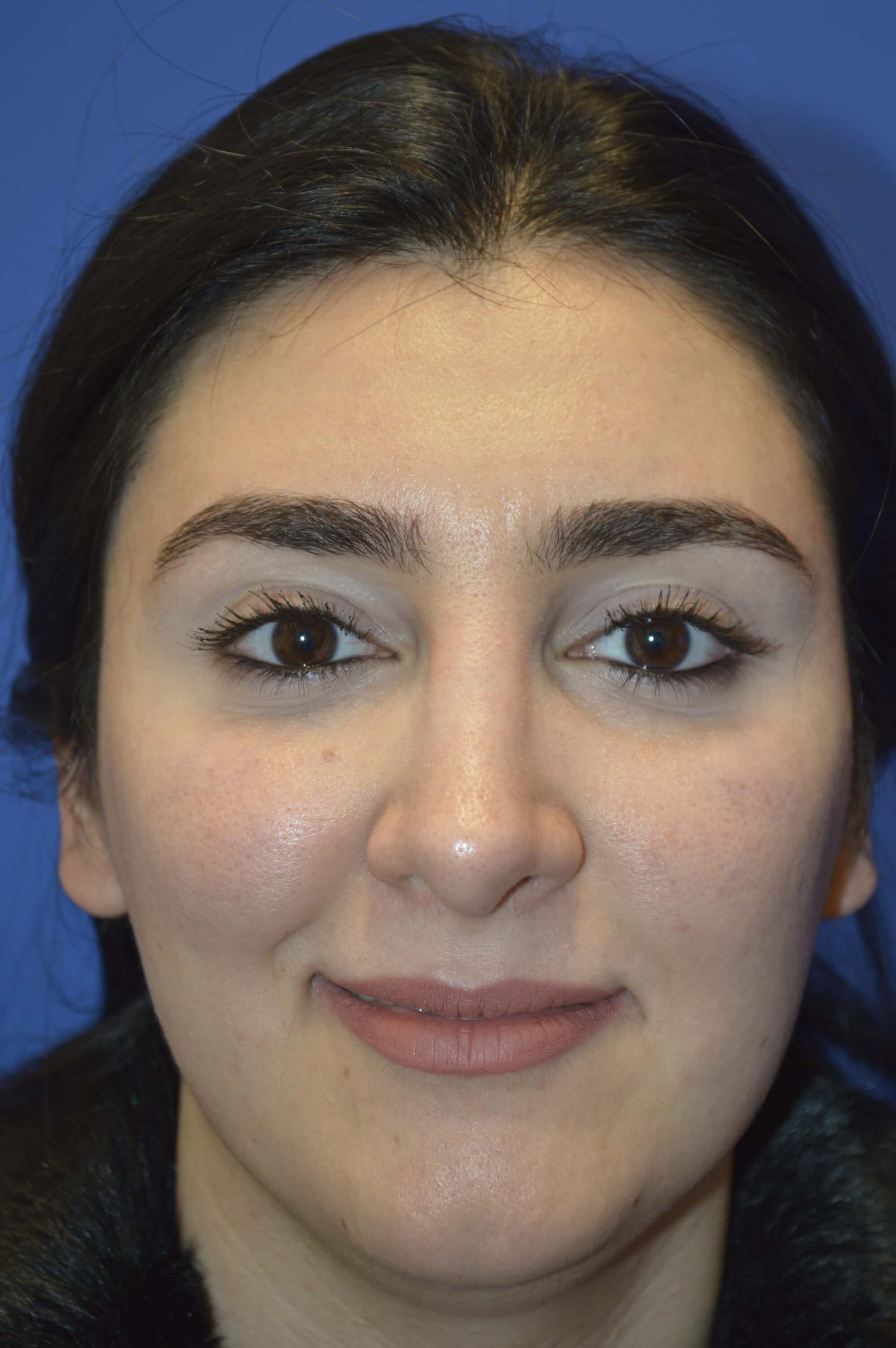 Rhinoplasty Washington DC After-front view