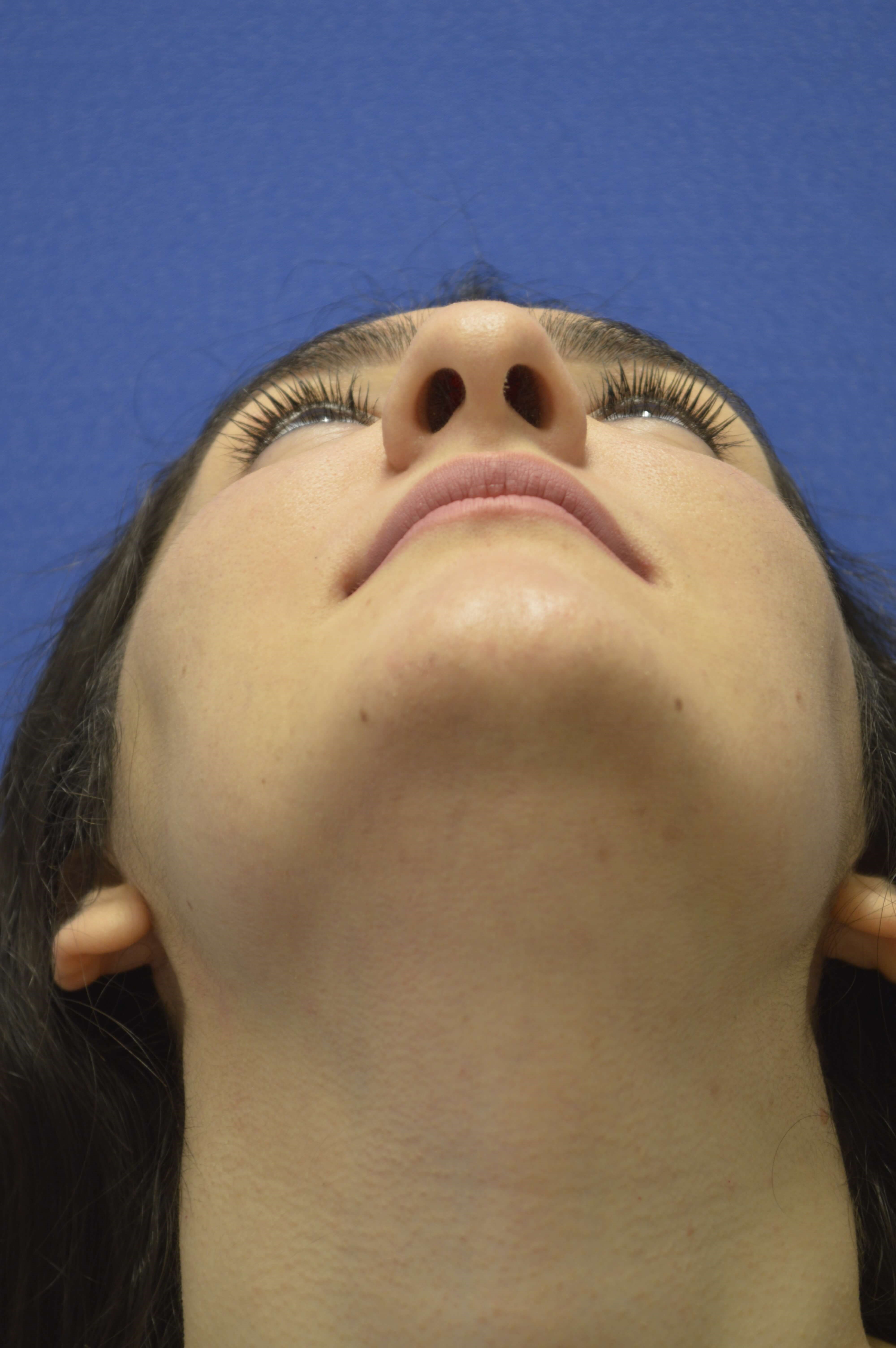 Rhinoplasty Washington DC Before