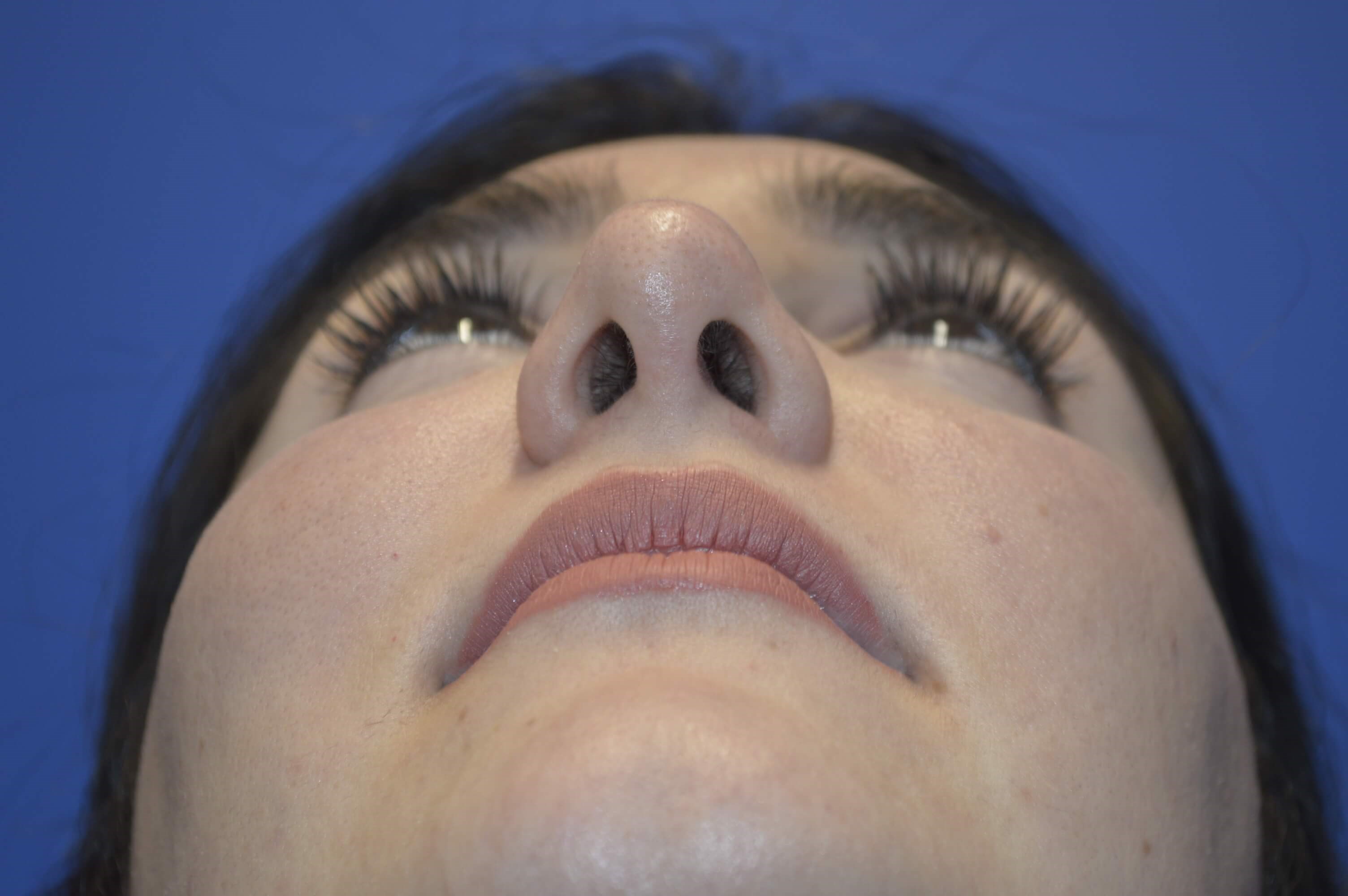 Rhinoplasty Washington DC After
