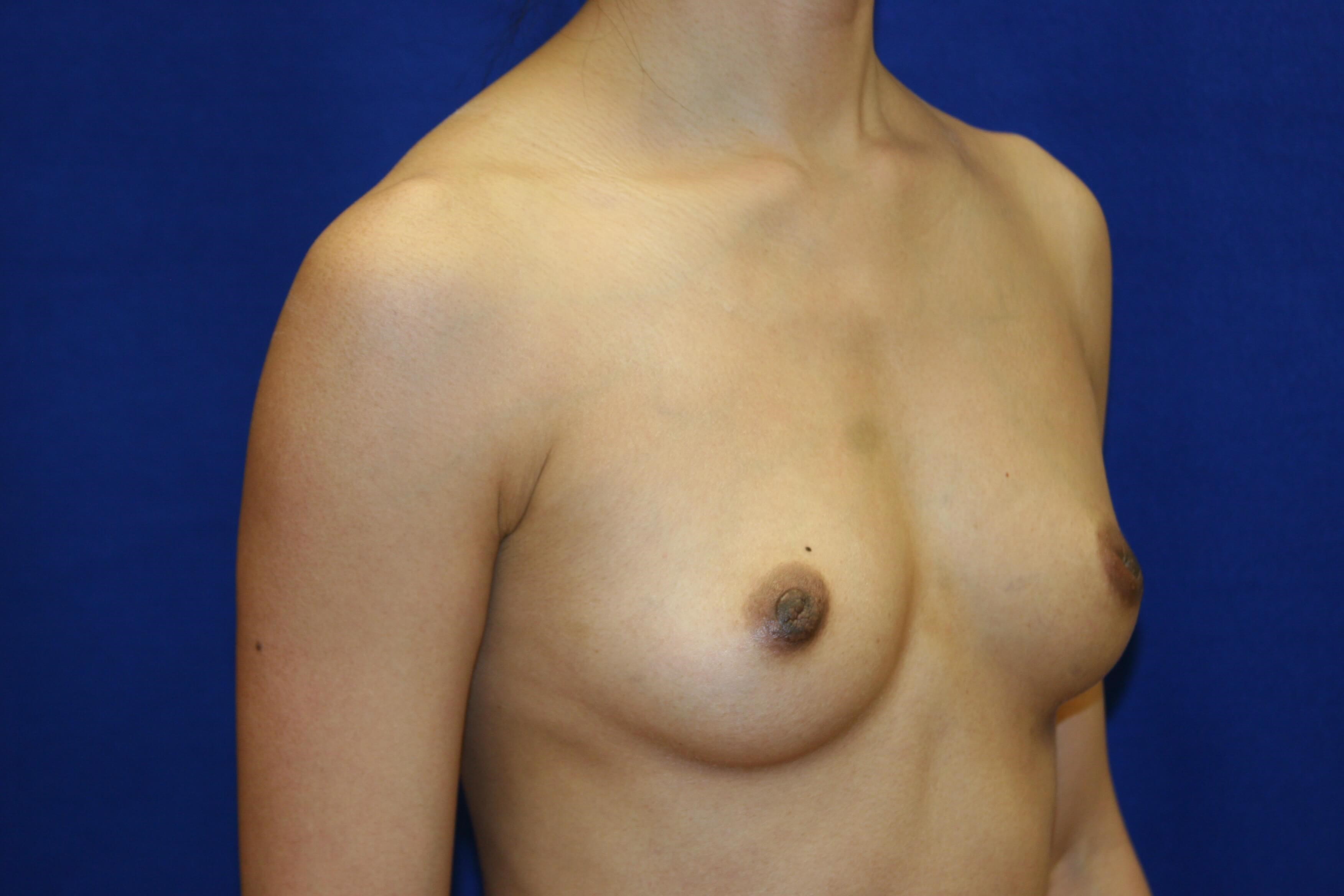 Breast Augmentation DC Before