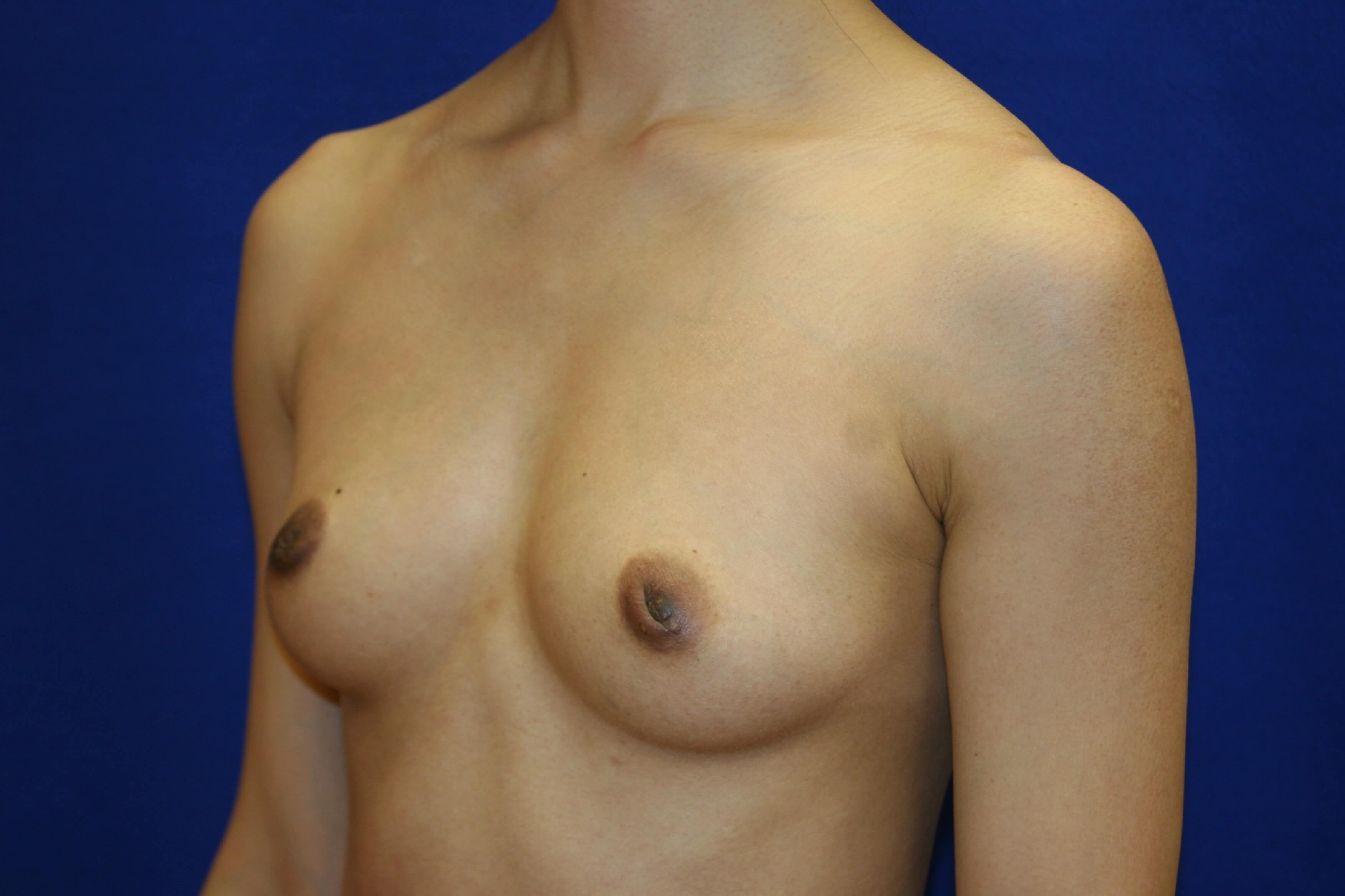 Breast Augmentation DC Before