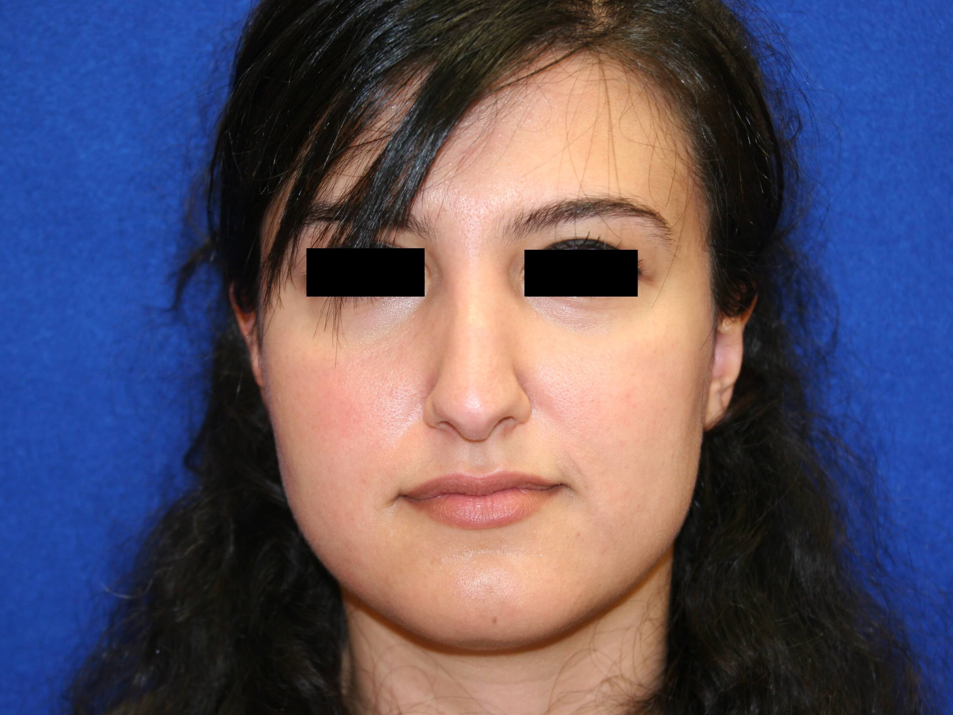 Rhinoplasty DC Before