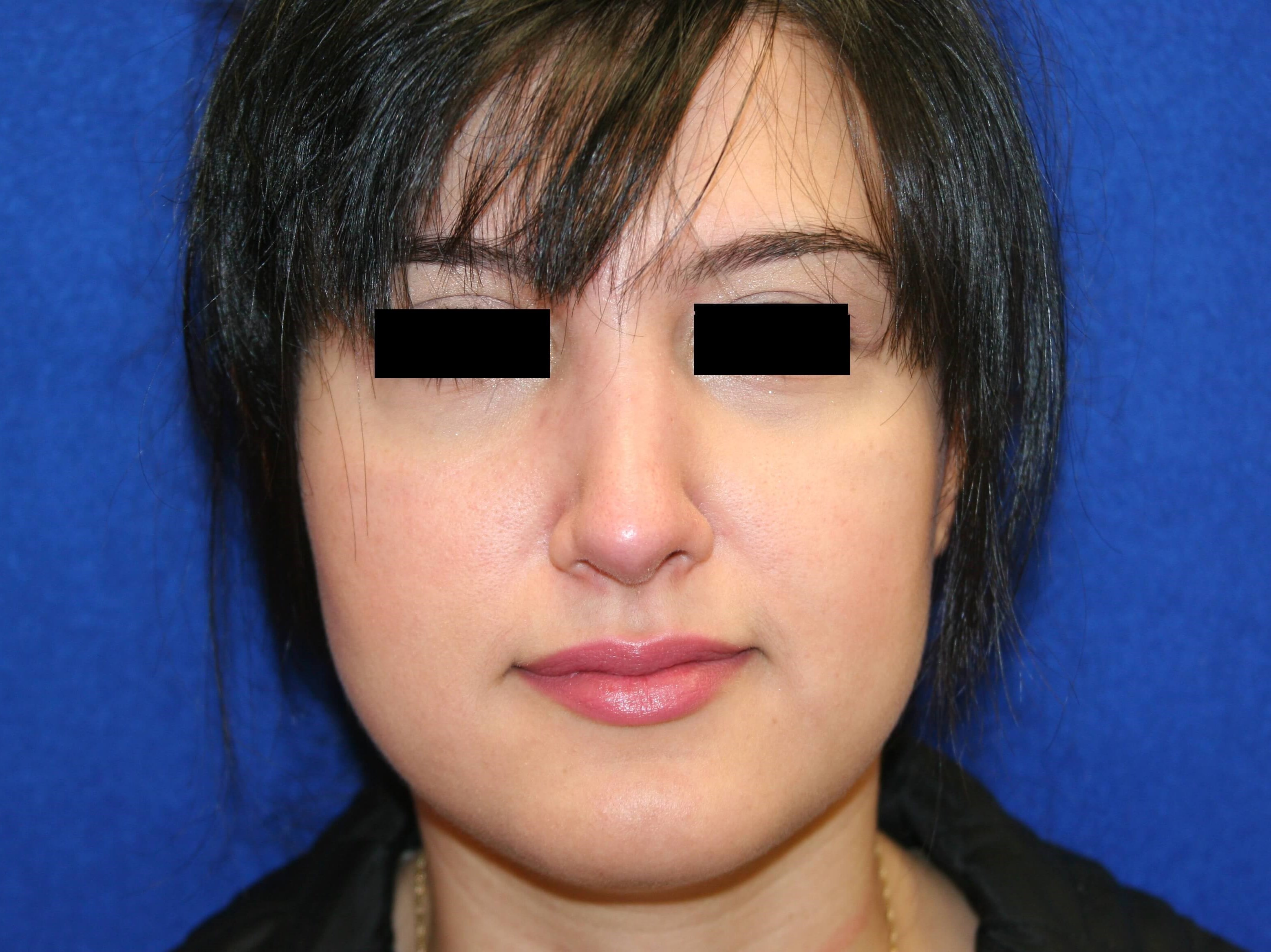 Rhinoplasty DC After