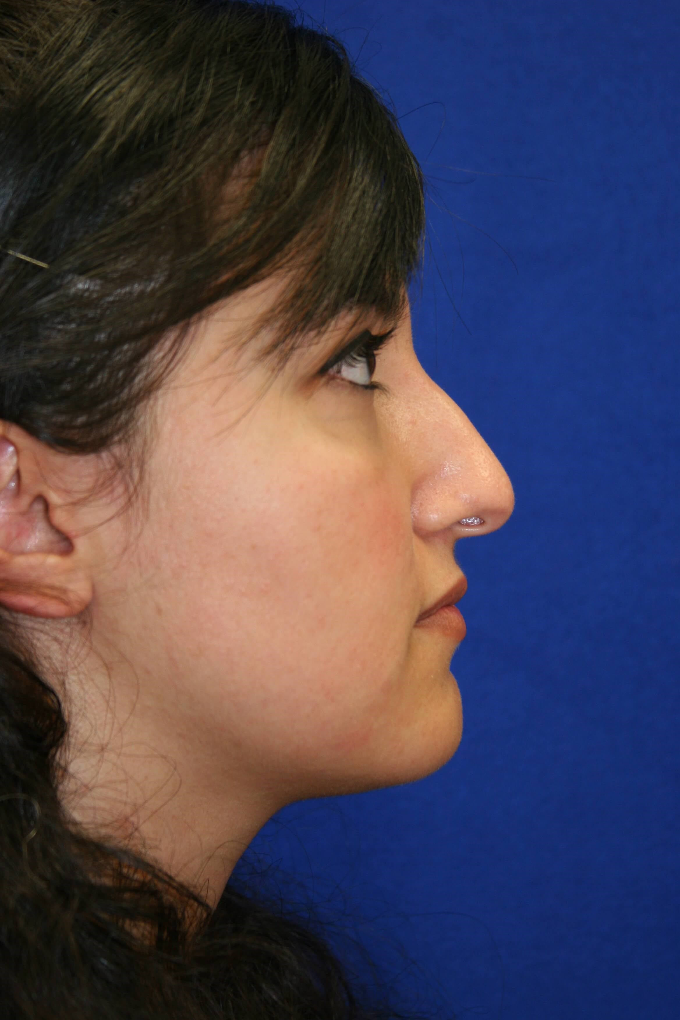 Rhinoplasty DC Before