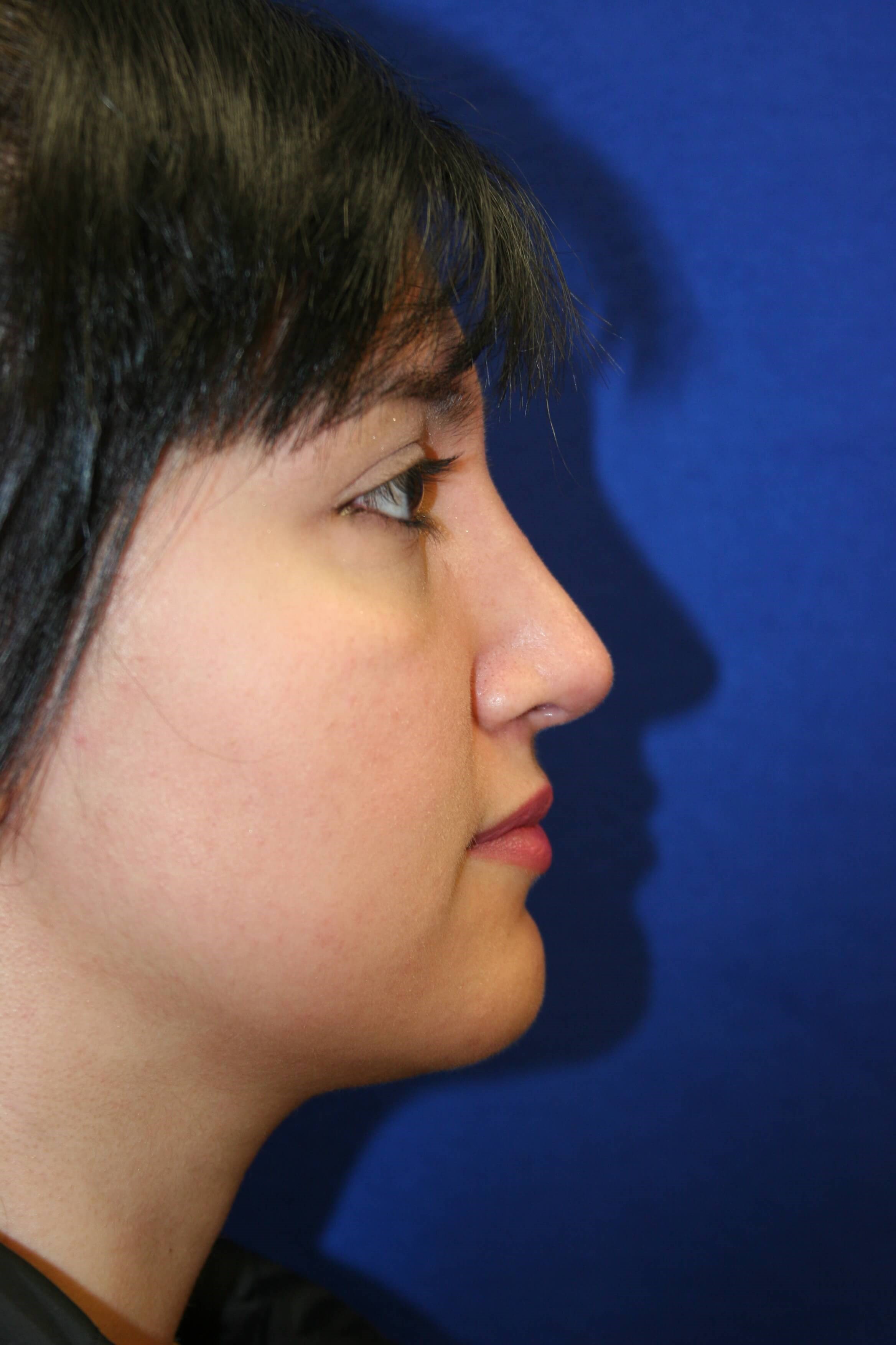 Rhinoplasty DC After