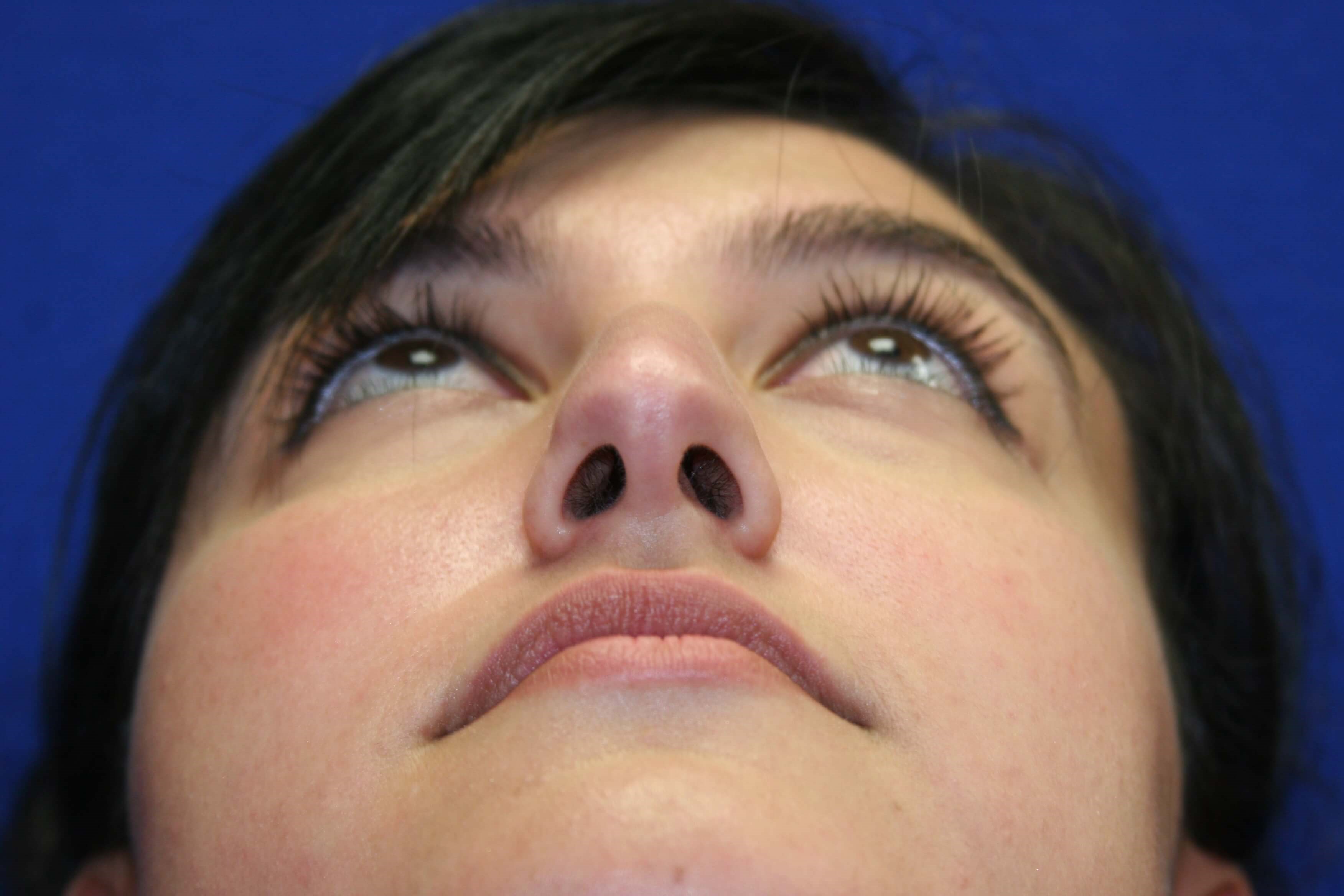 Rhinoplasty DC Before