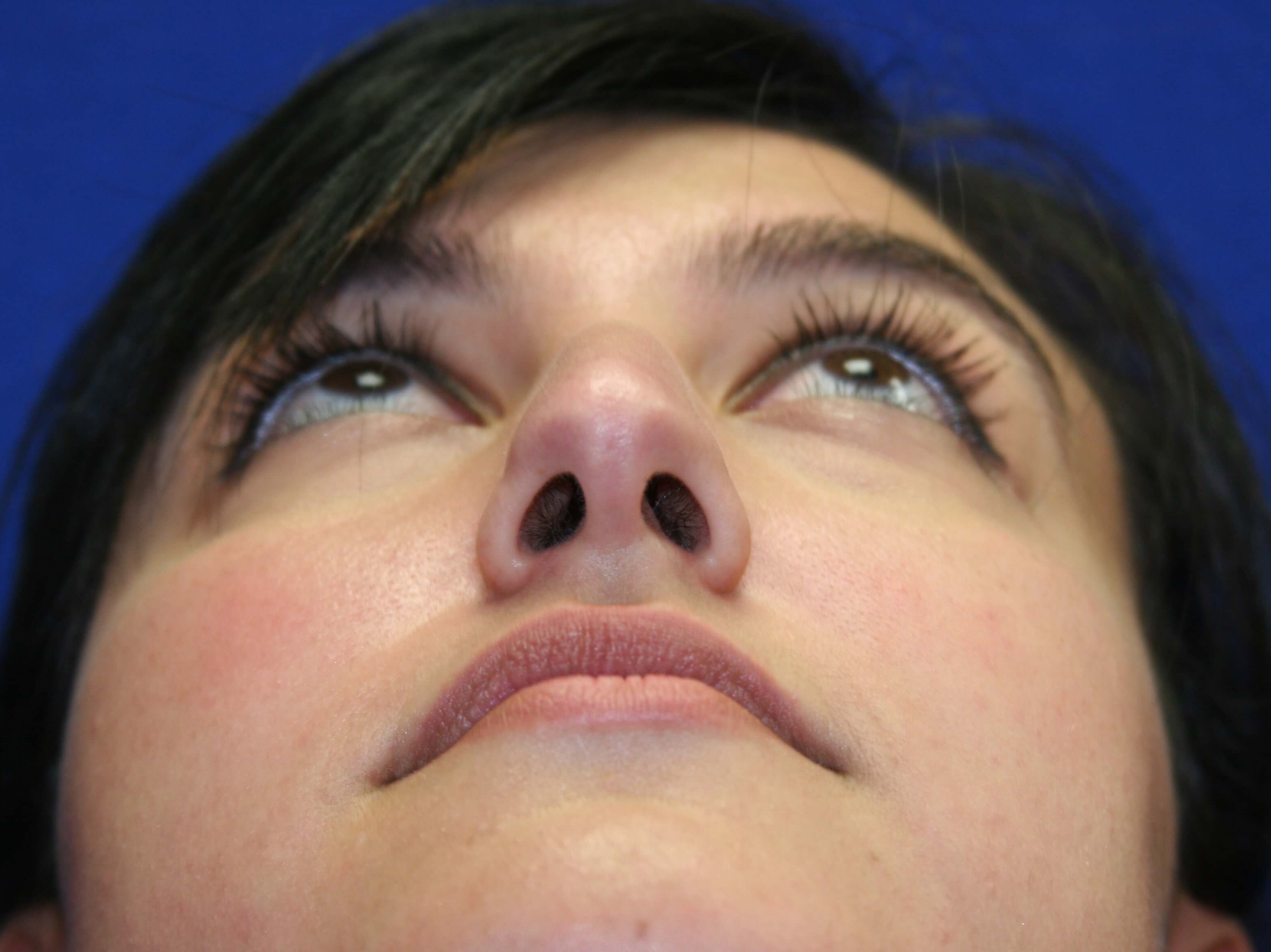 Rhinoplasty DC Before