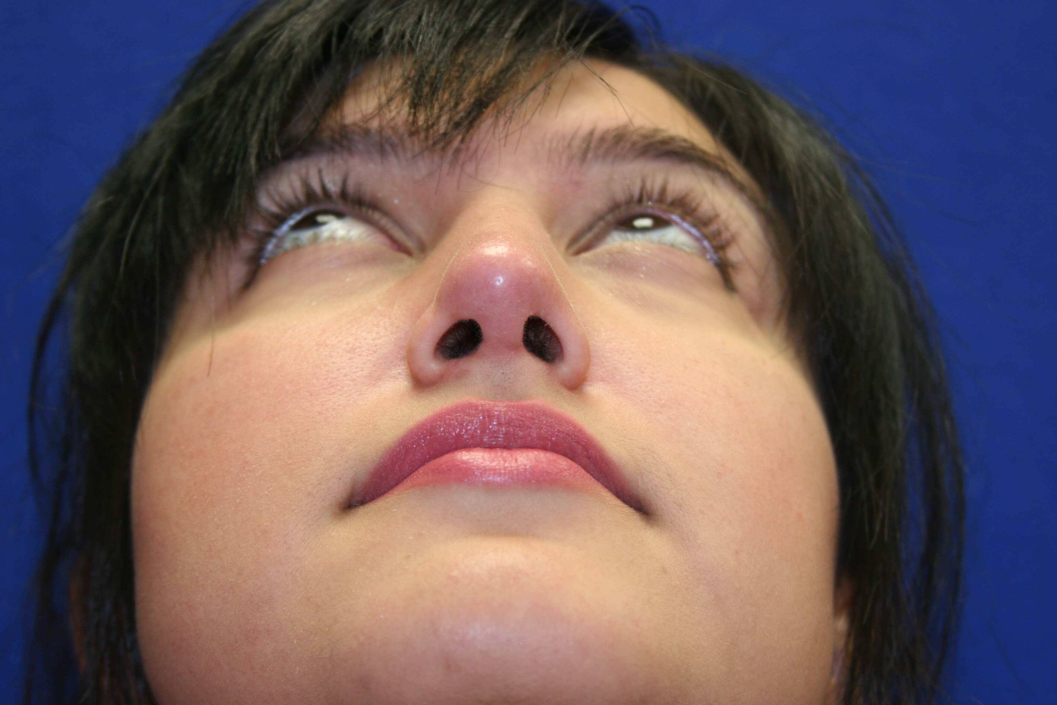 Rhinoplasty DC After