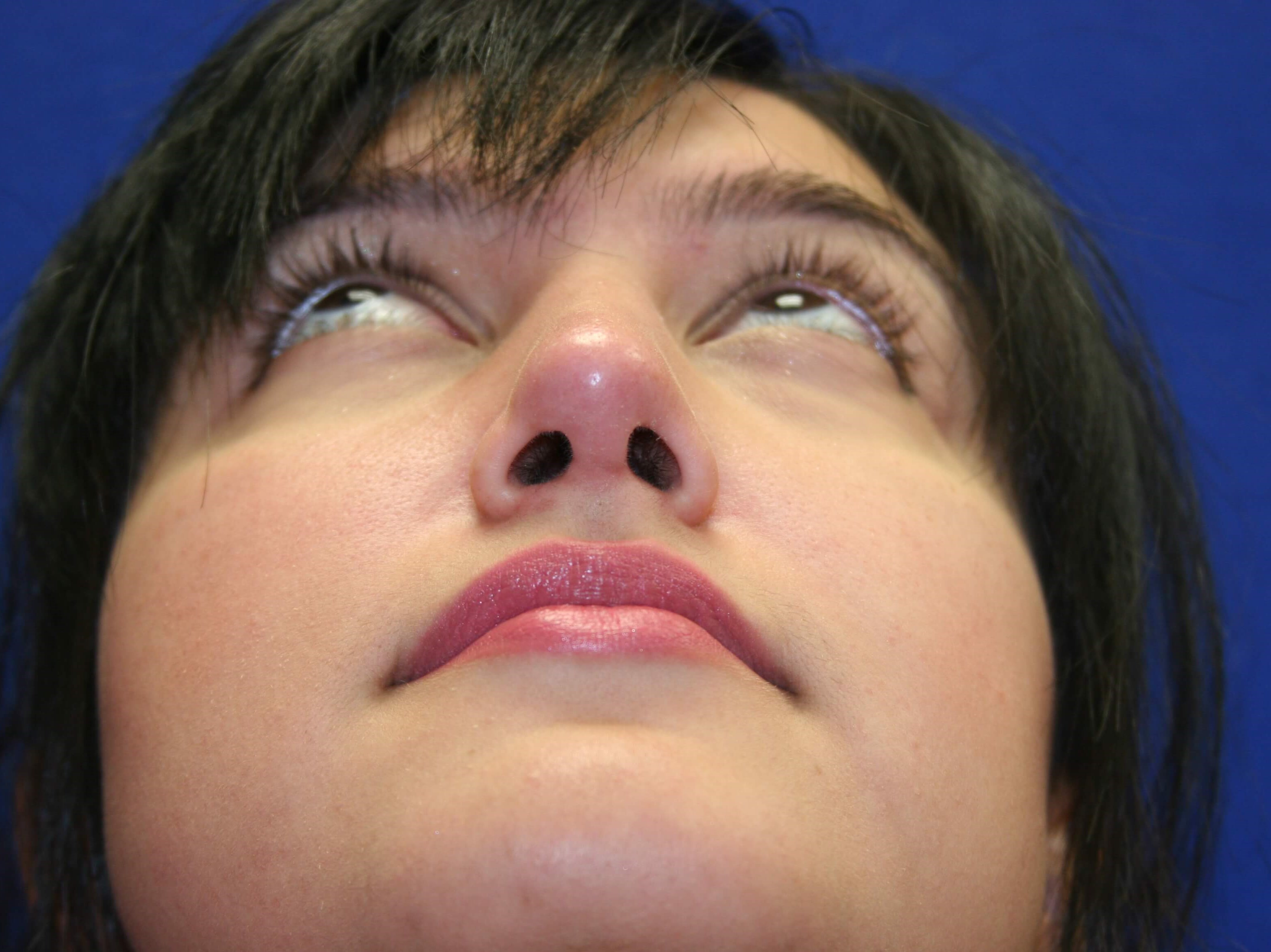Rhinoplasty DC After