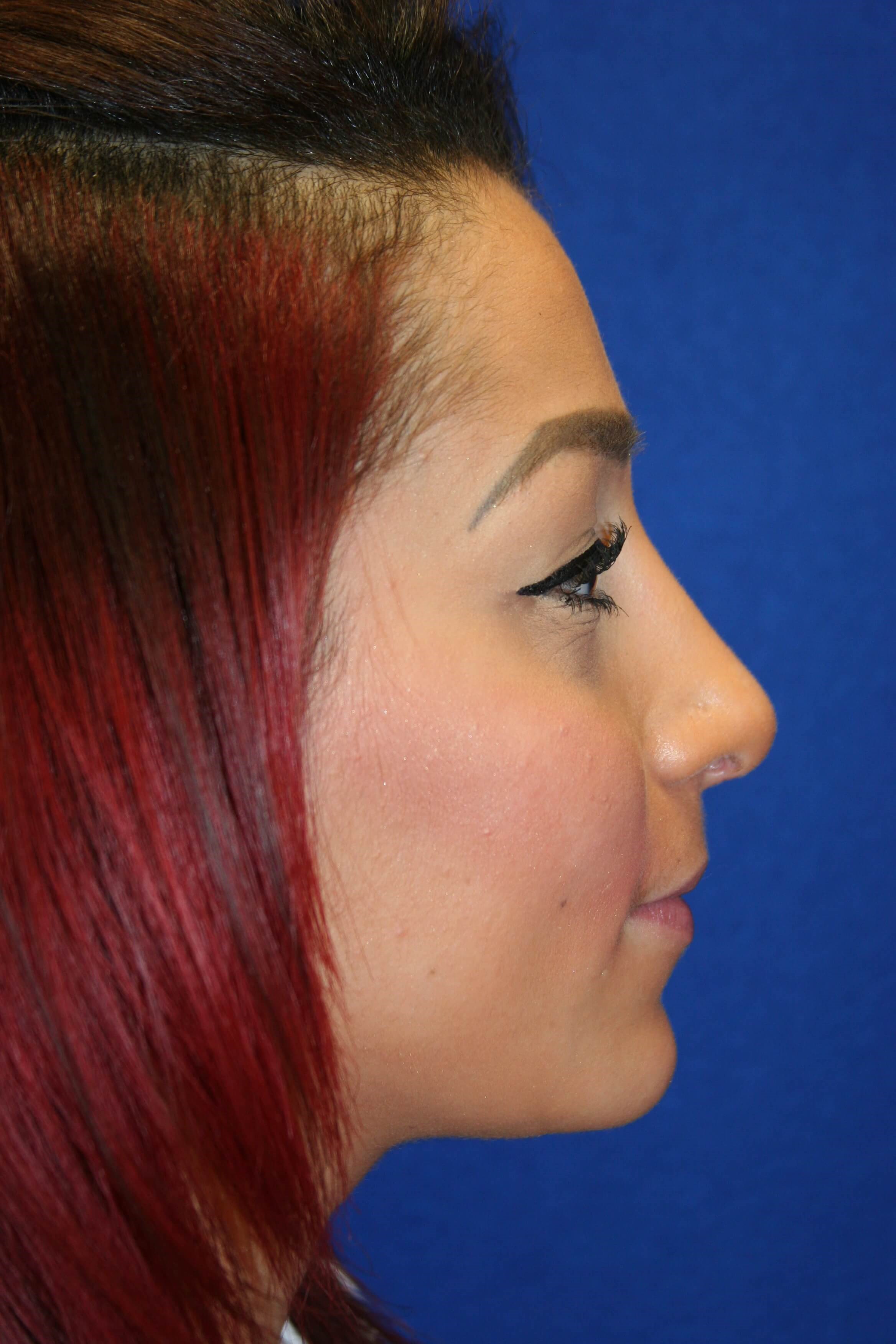 Rhinoplasty DC After
