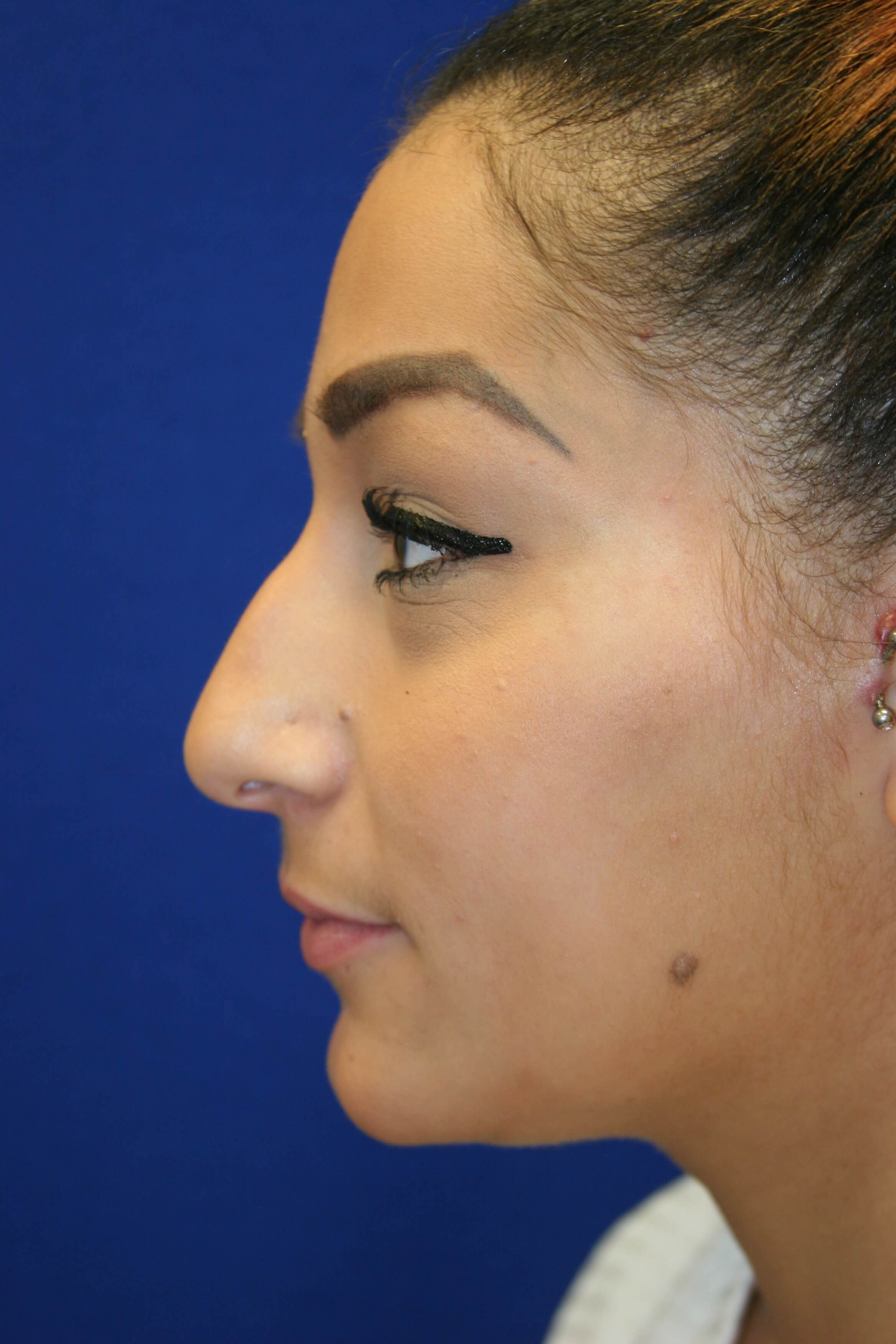 Rhinoplasty DC Before