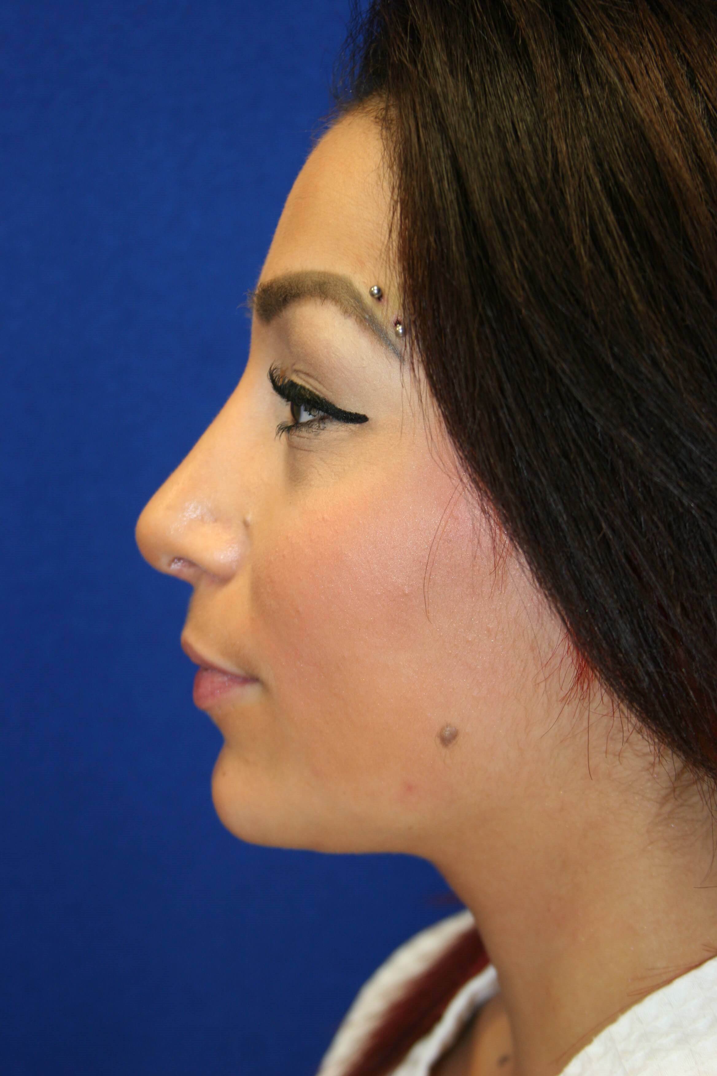 Rhinoplasty DC After