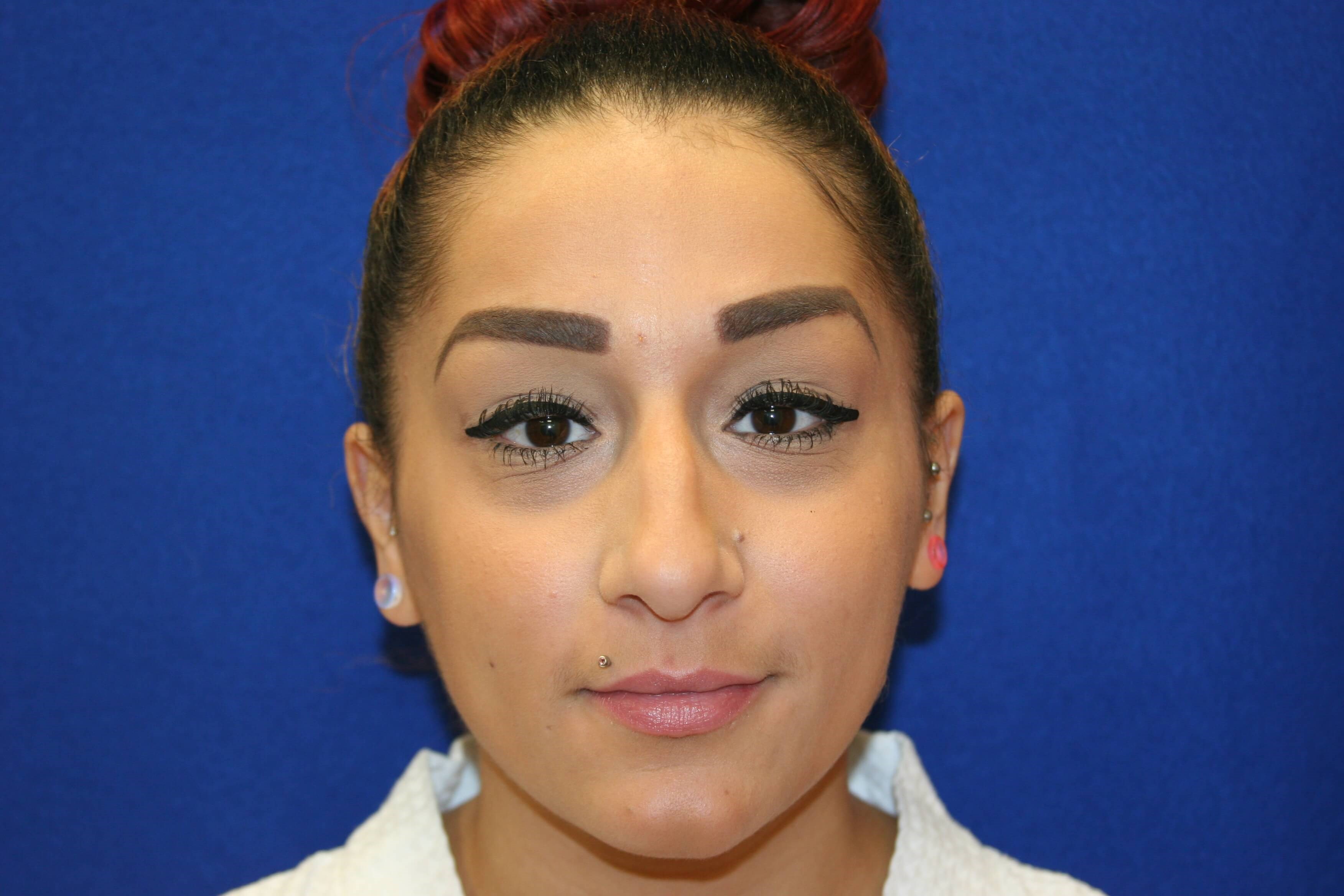 Rhinoplasty DC Before