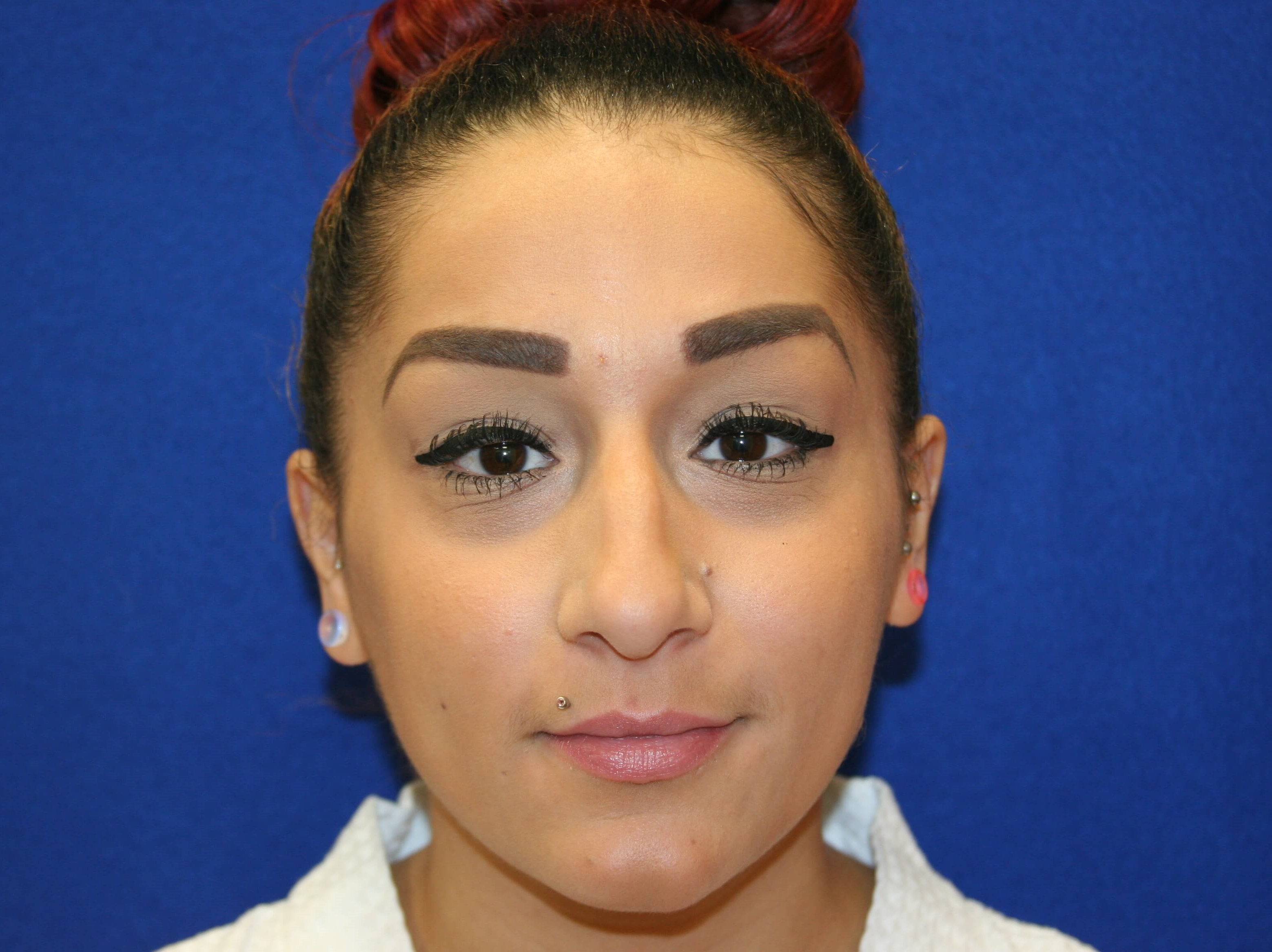 Rhinoplasty DC Before