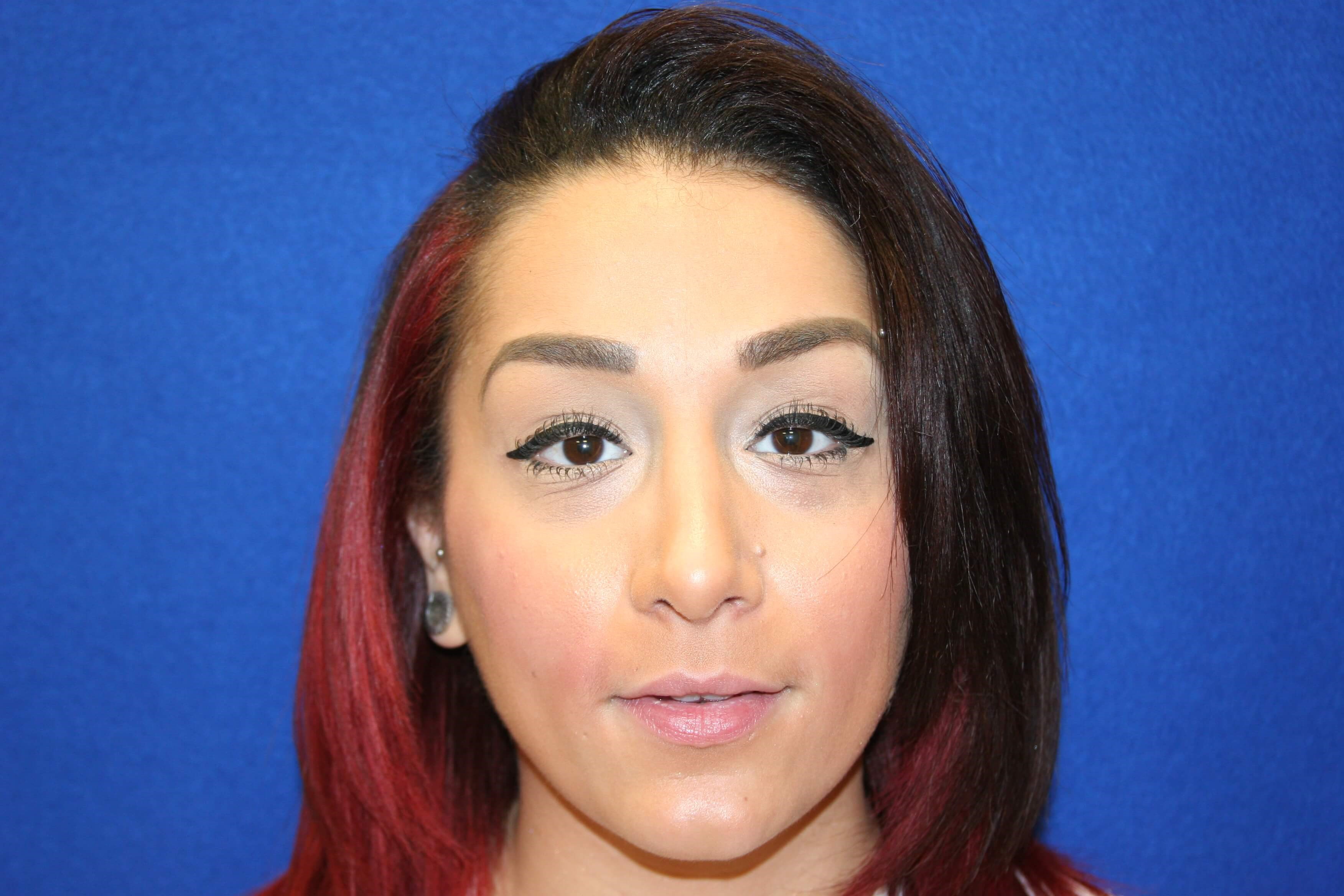 Rhinoplasty DC After
