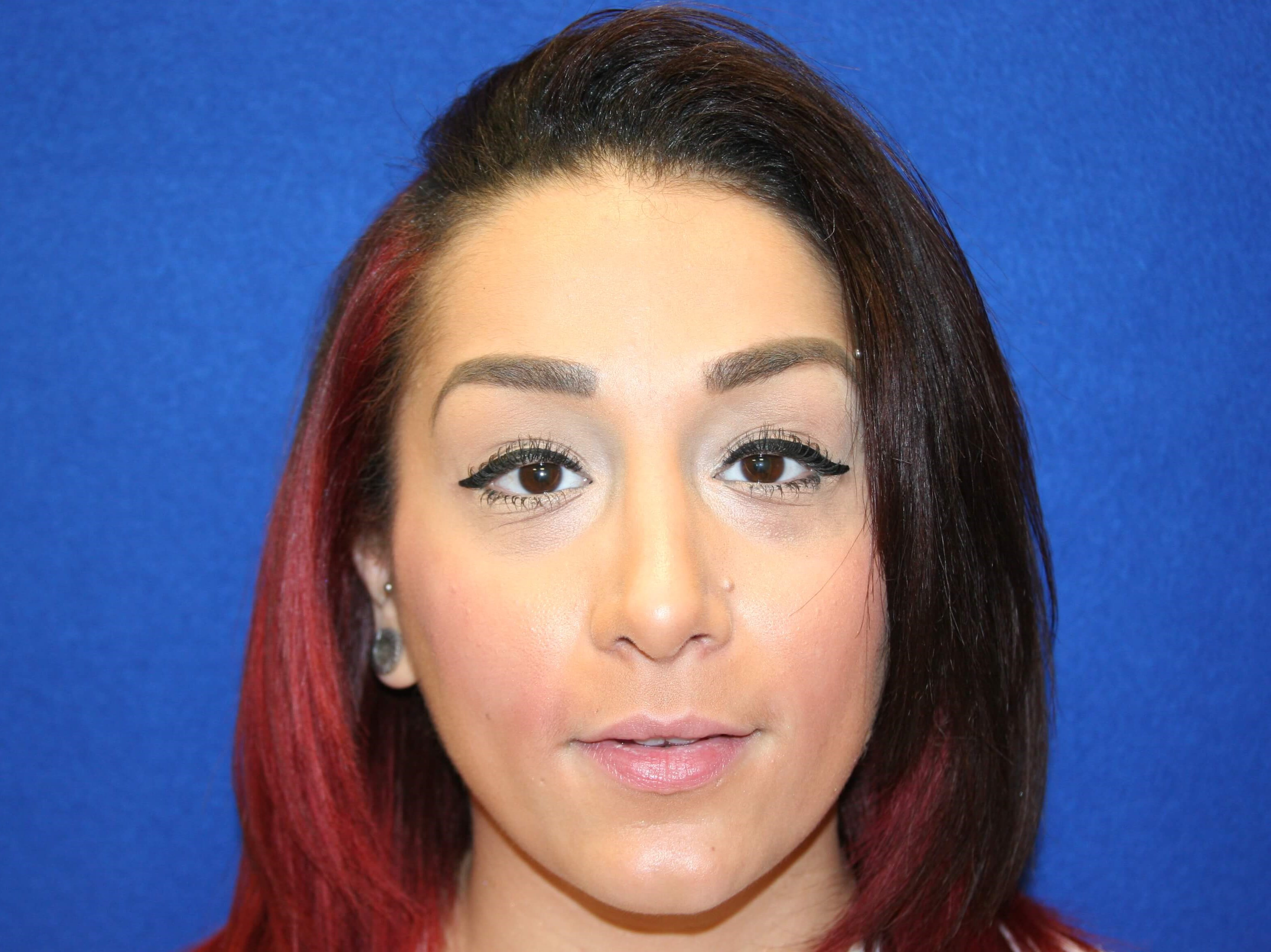 Rhinoplasty DC After