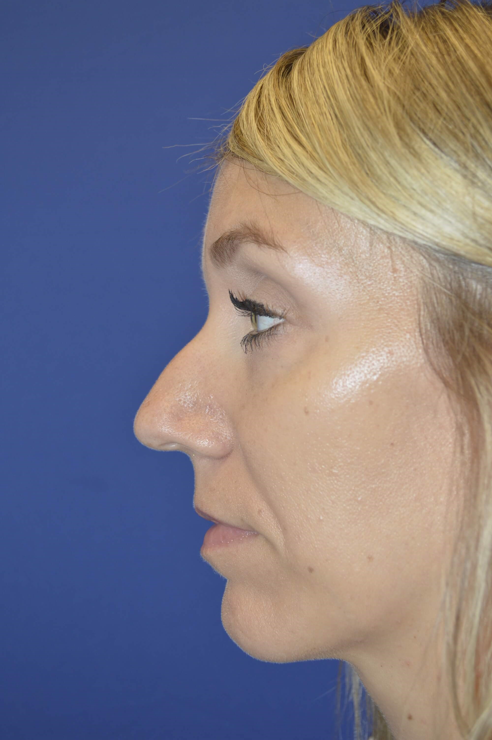 Rhinoplasty DC Before