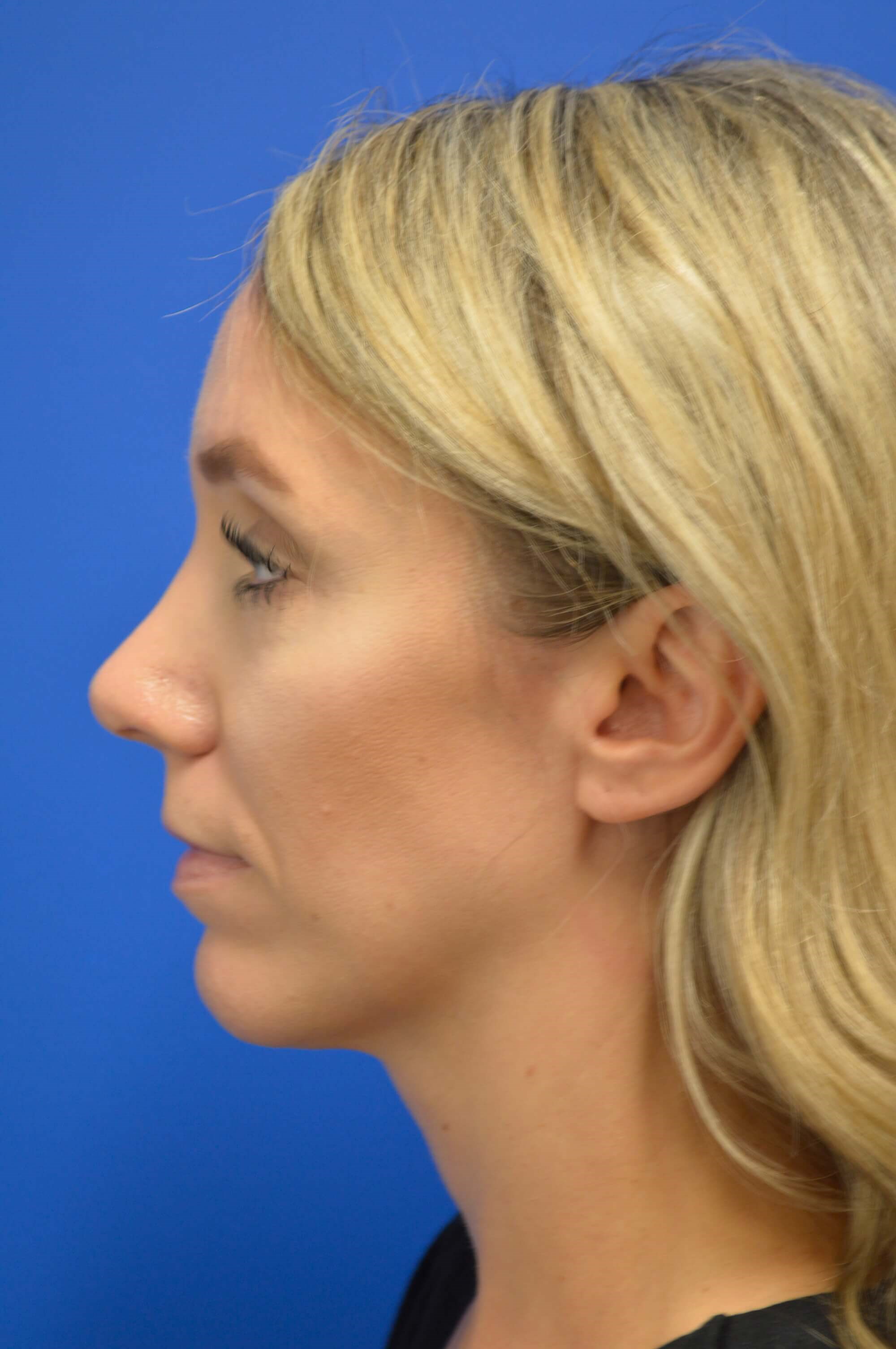 Rhinoplasty DC After