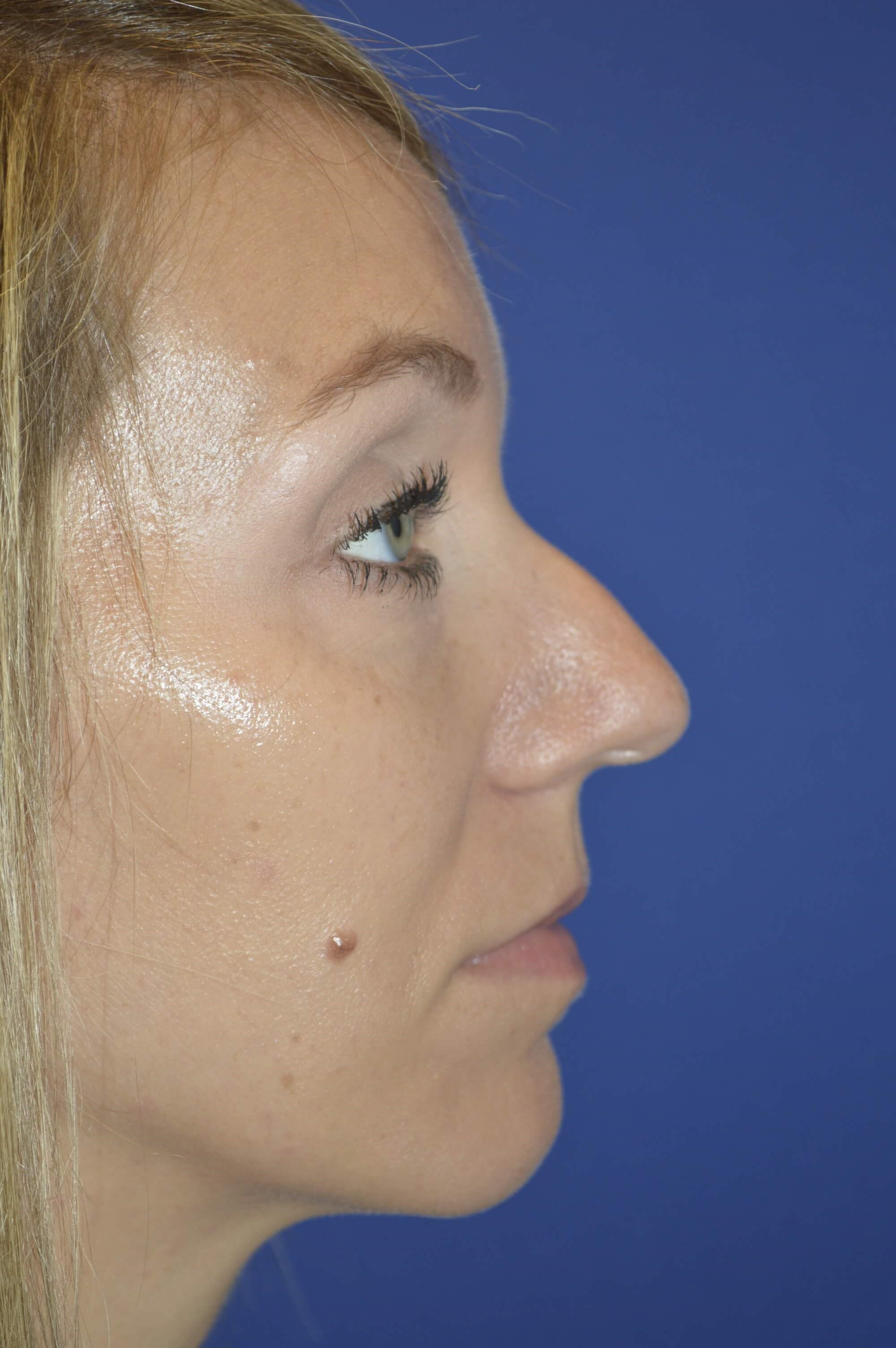 Rhinoplasty DC Before