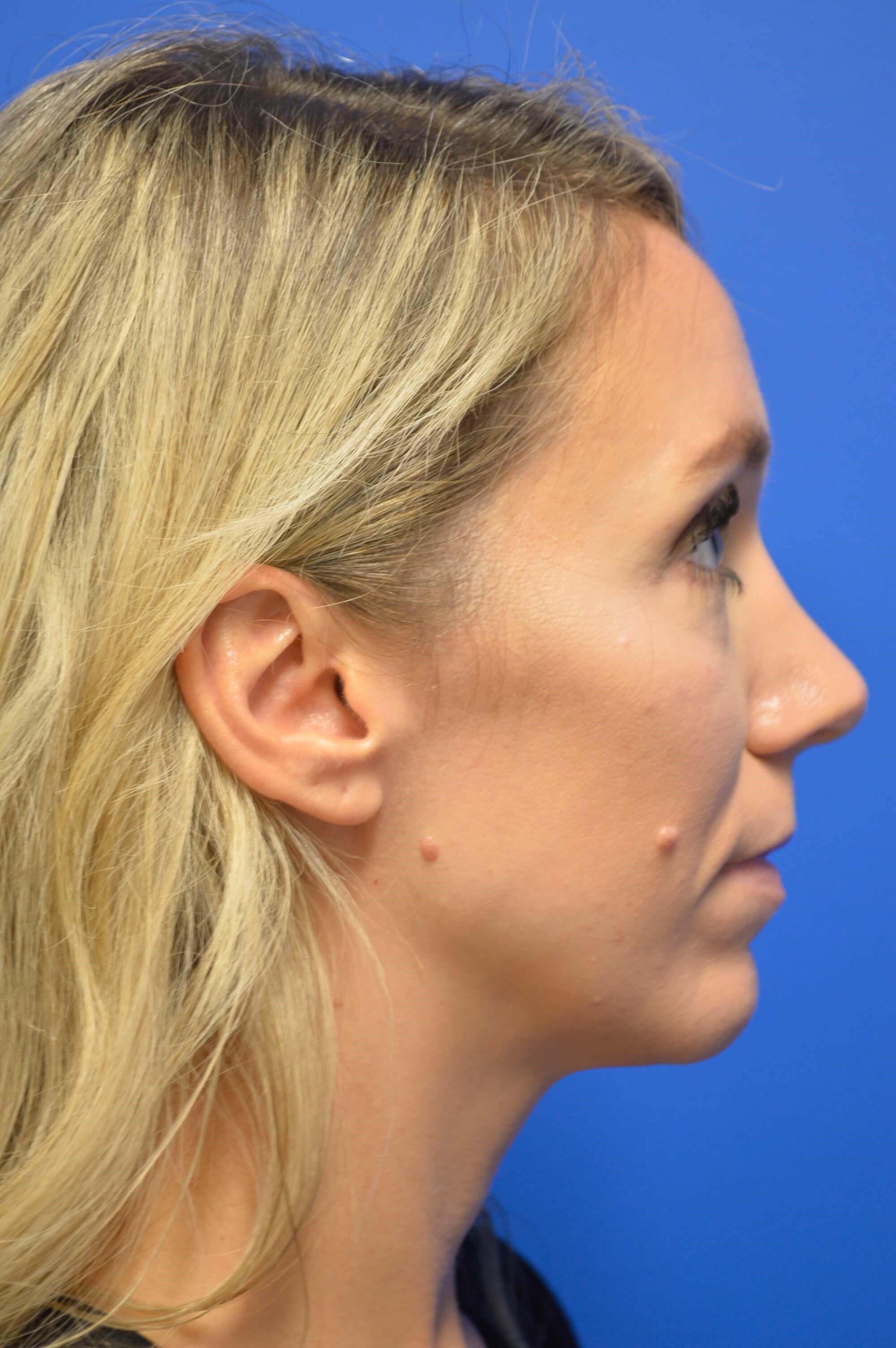 Rhinoplasty DC After