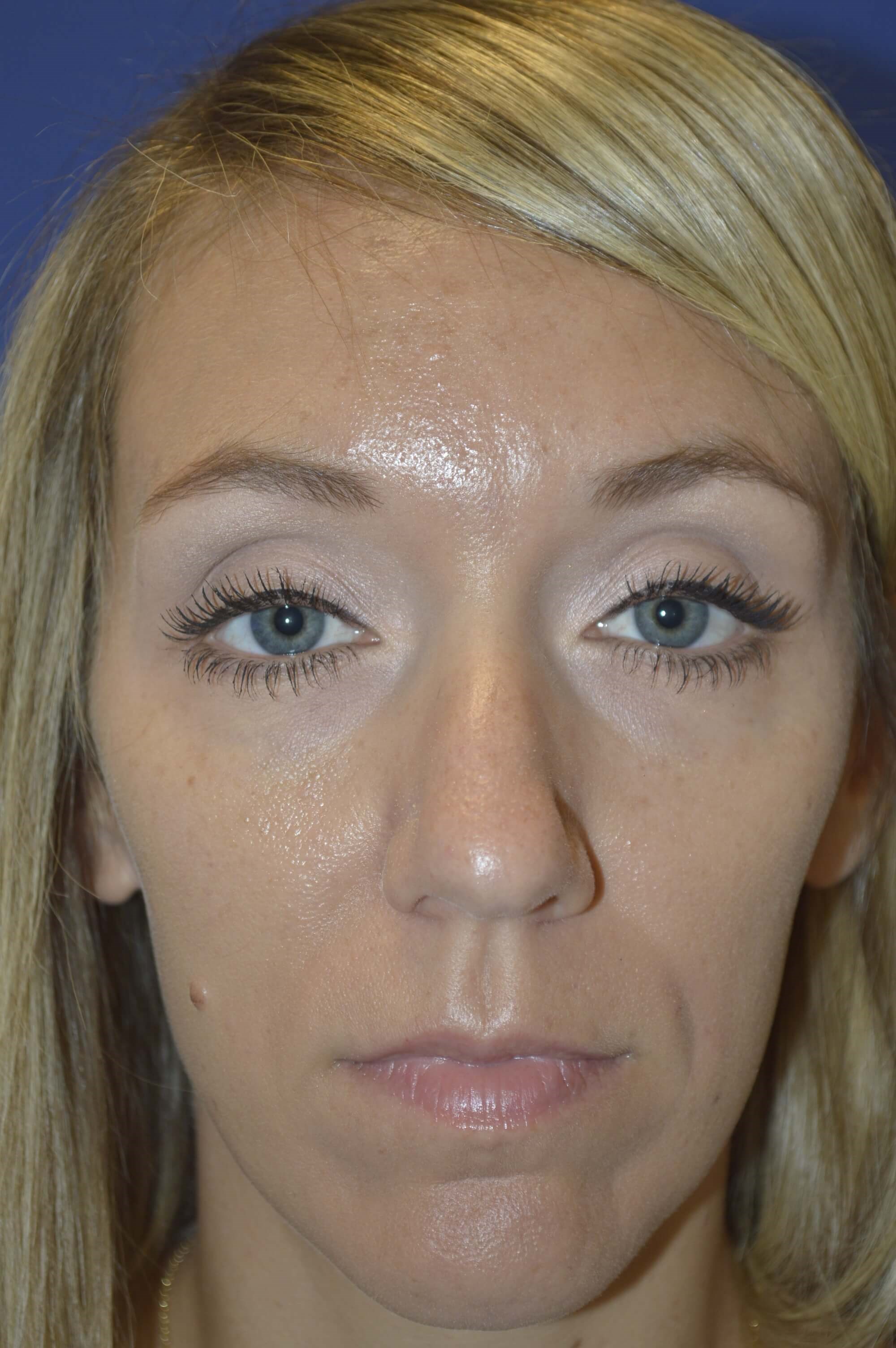 Rhinoplasty Mclean Before