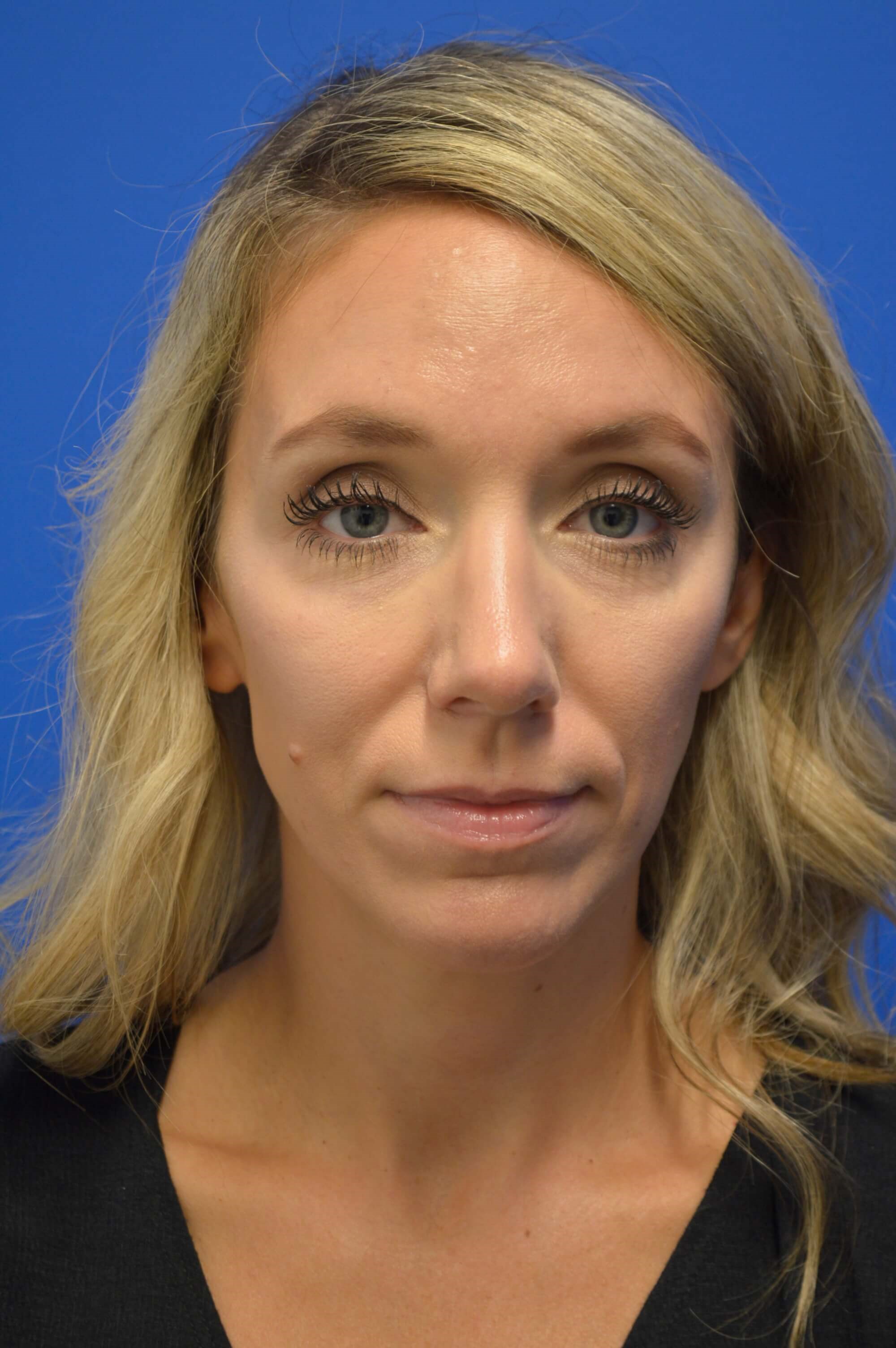 Rhinoplasty Mclean After