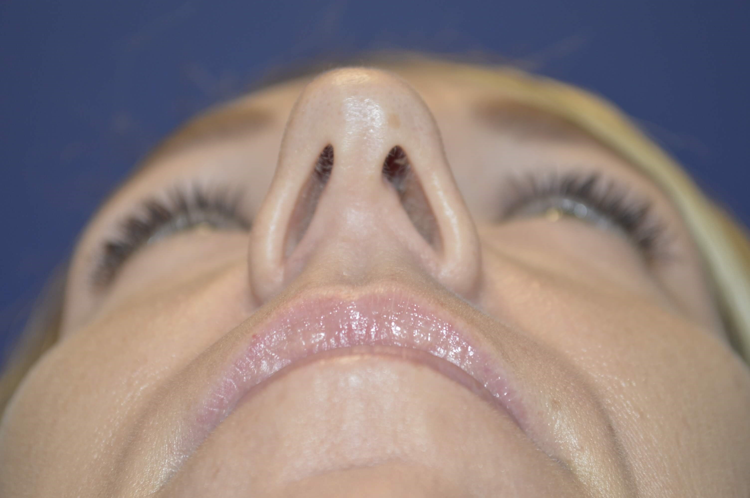 Rhinoplasty McLean Before