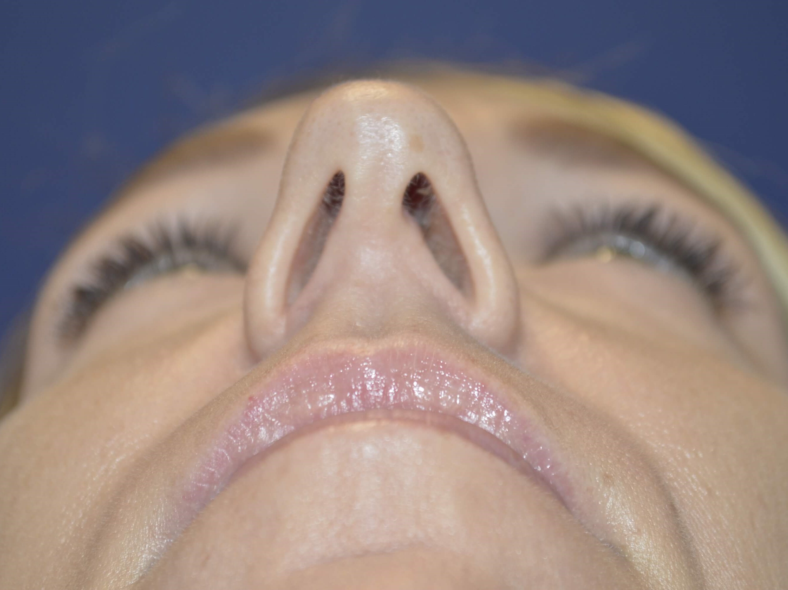 Rhinoplasty McLean Before