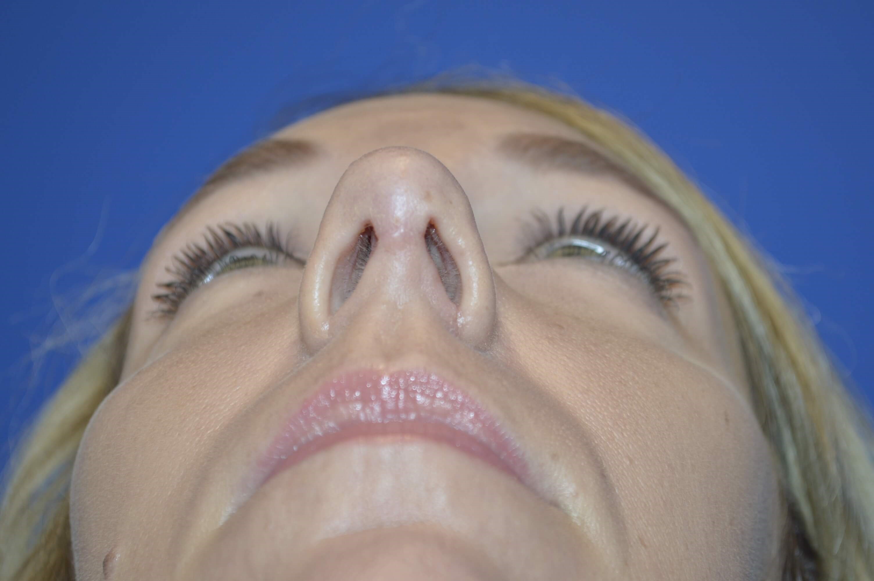 Rhinoplasty McLean After