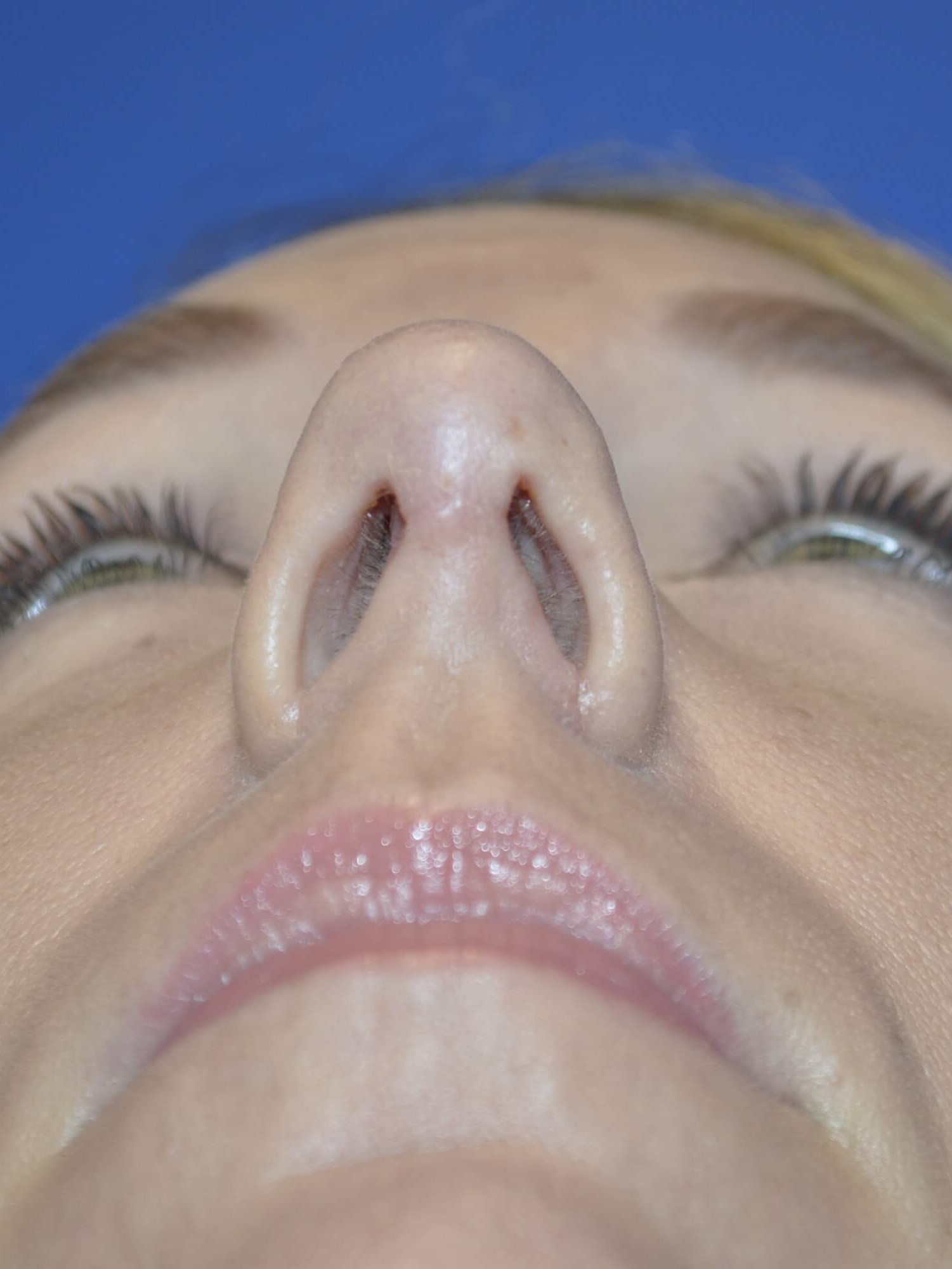 Rhinoplasty McLean After