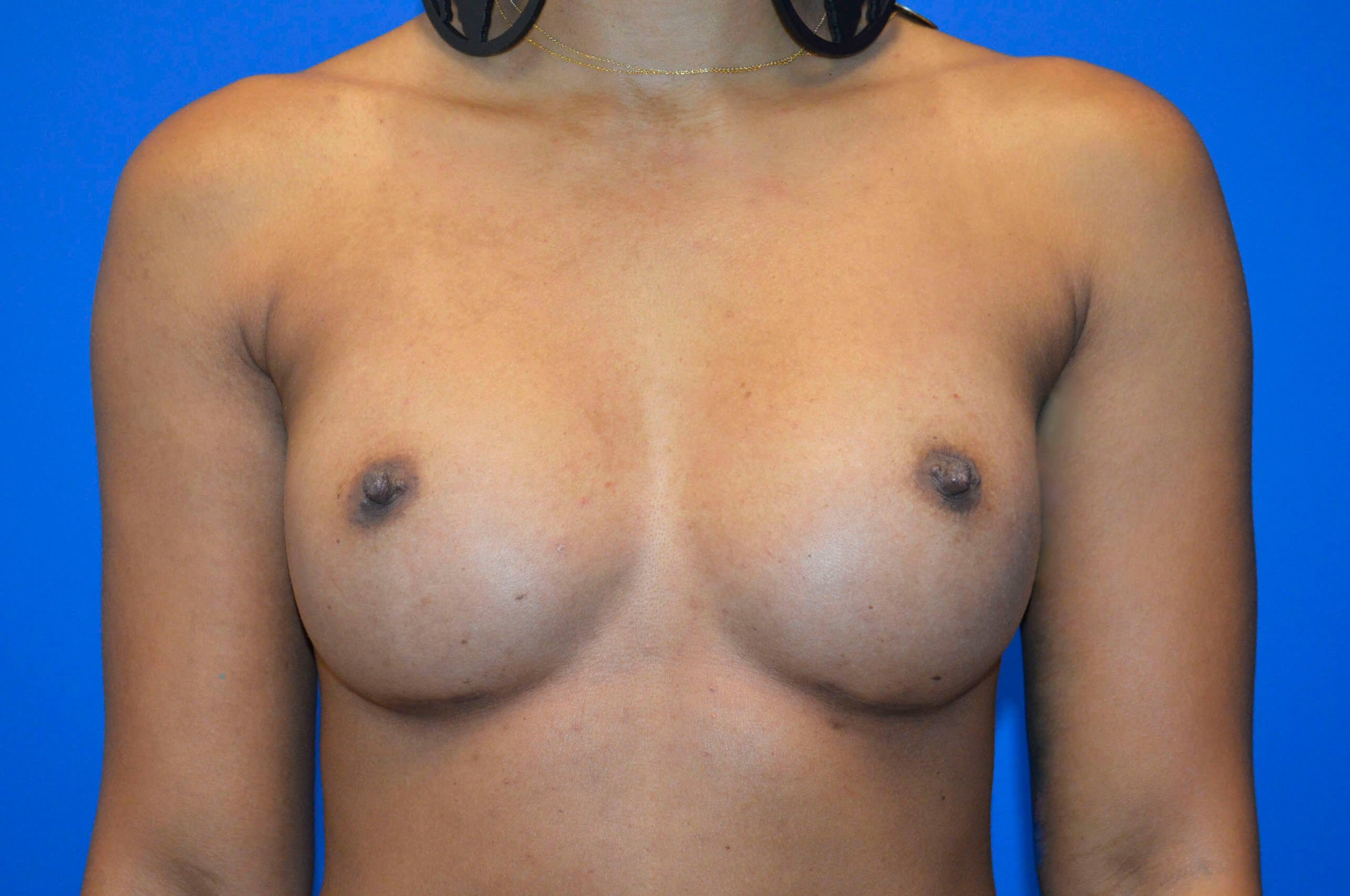 Breast Augmentation: Front After