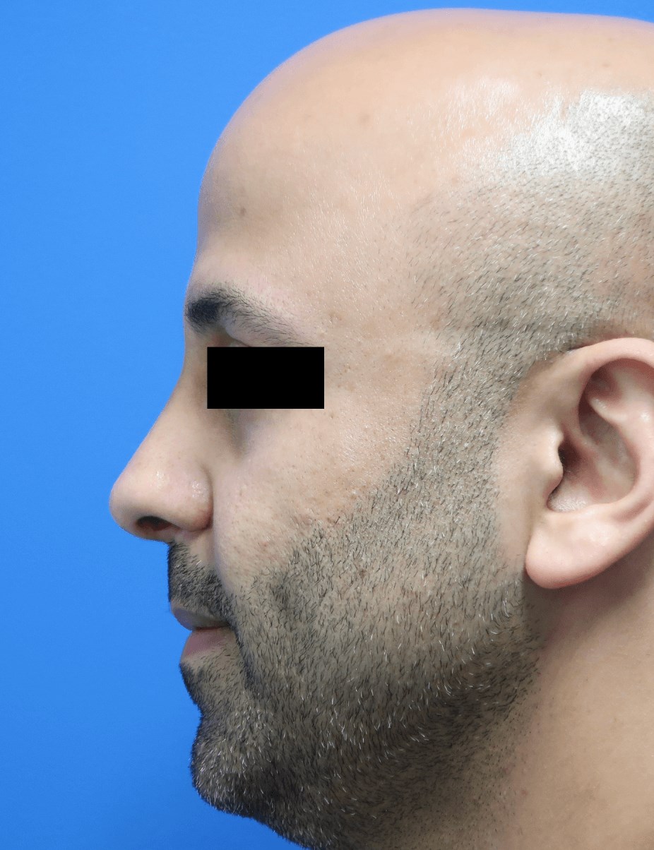 Male Rhinoplasty: Profile View After