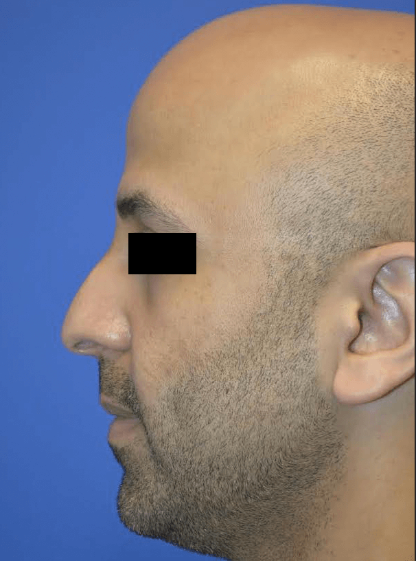Male Rhinoplasty: Profile View Before
