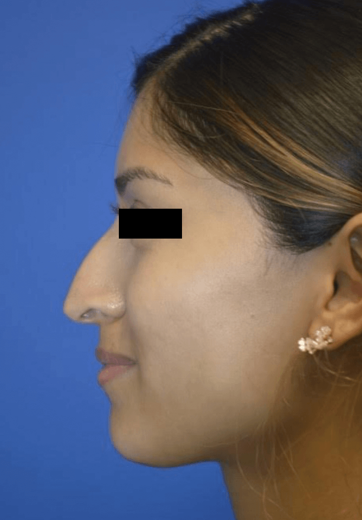 Rhinoplasty: Profile Before