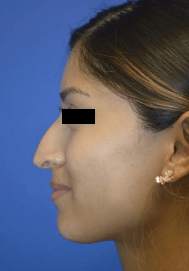 Rhinoplasty: Profile Before