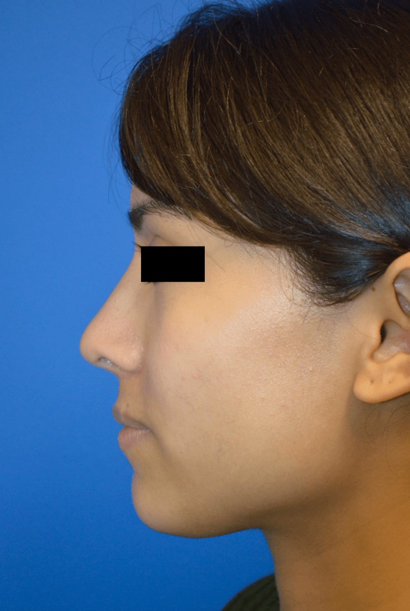 Rhinoplasty: Profile After