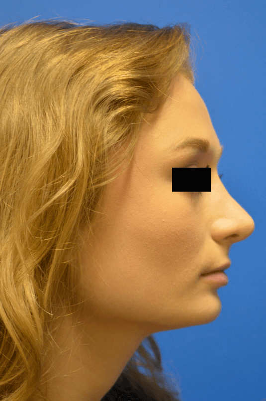 Rhinoplasty: Profile After