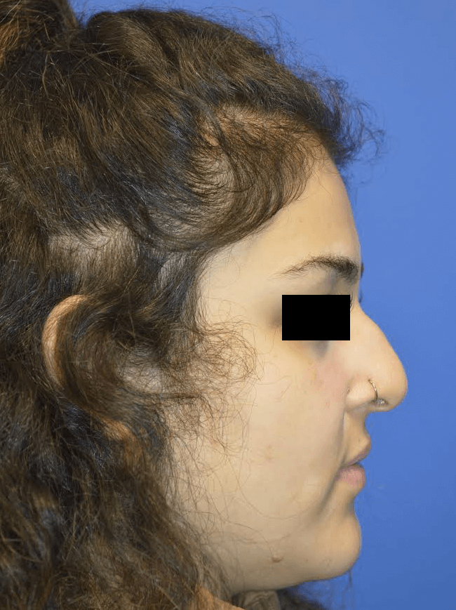 Rhinoplasty: Profile Before