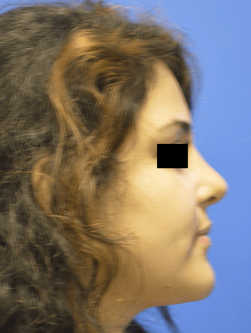 Rhinoplasty: Profile After