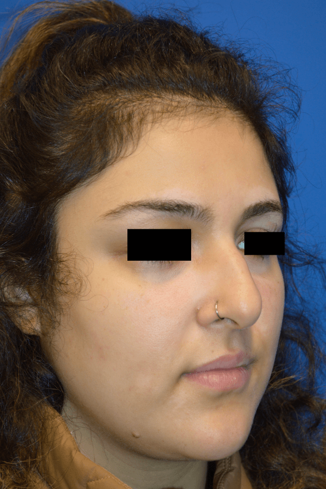 Rhinoplasty: Angle Before