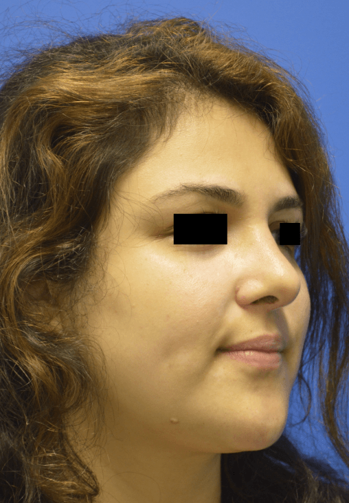 Rhinoplasty: Angle After