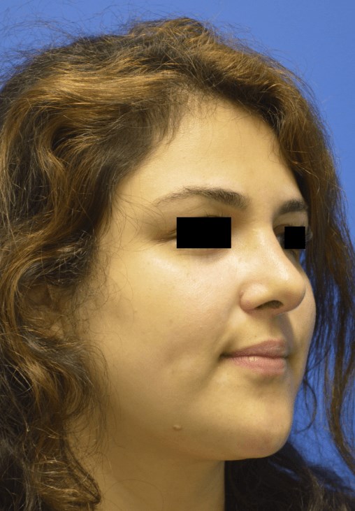 Rhinoplasty: Angle After