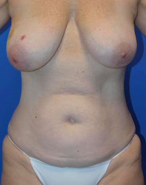 Full Body View Before