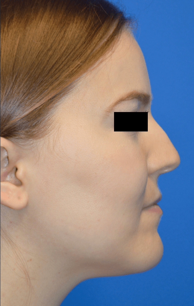 Rhinoplasty: Profile Before