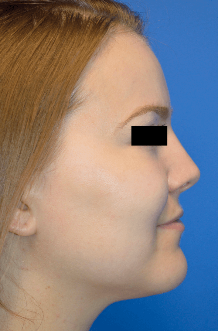 Rhinoplasty: Profile After