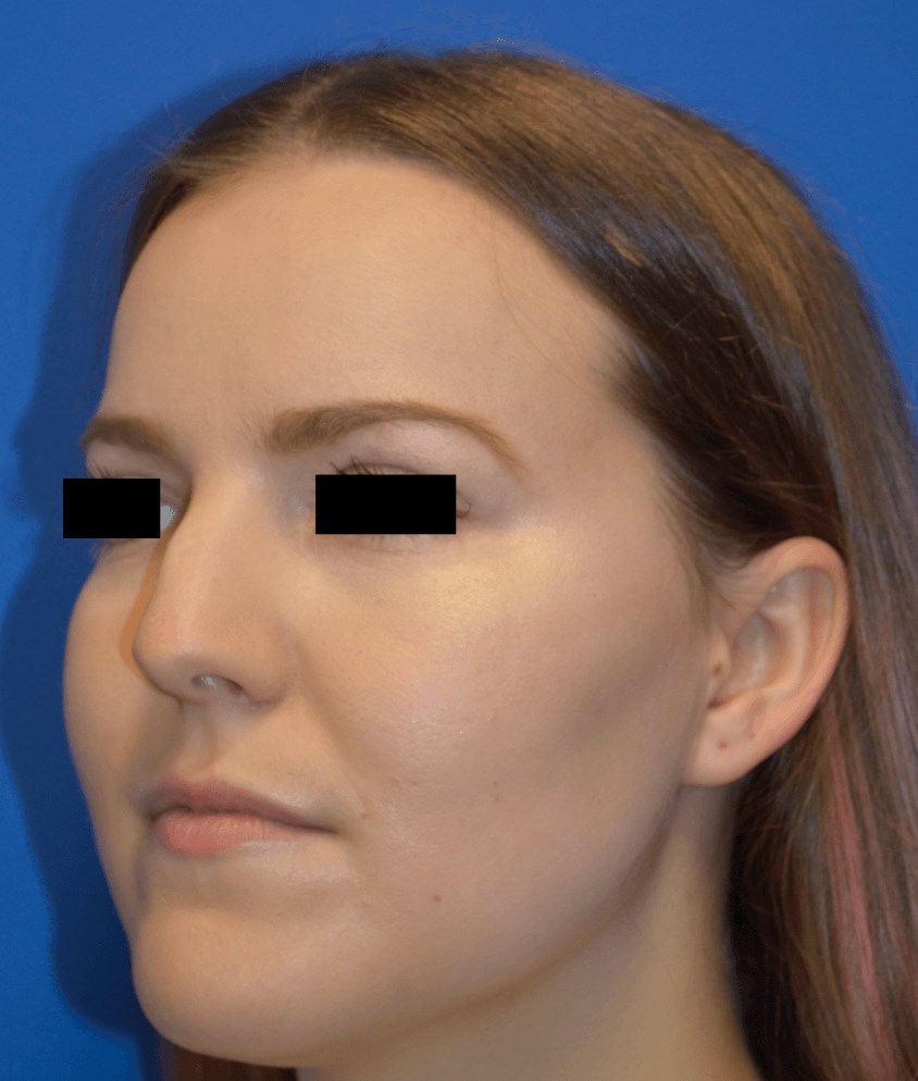 Rhinoplasty: Angle Before